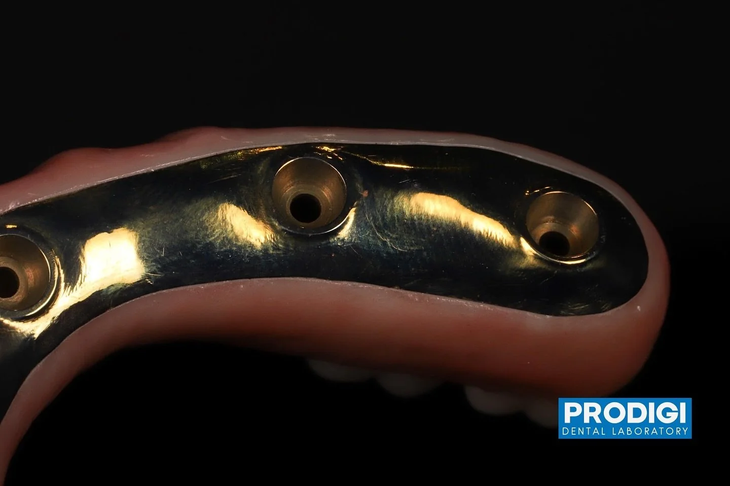 Material selection for full arch reconstruction.
Titanium reinforced fixed prosthetics with @prostho.dental