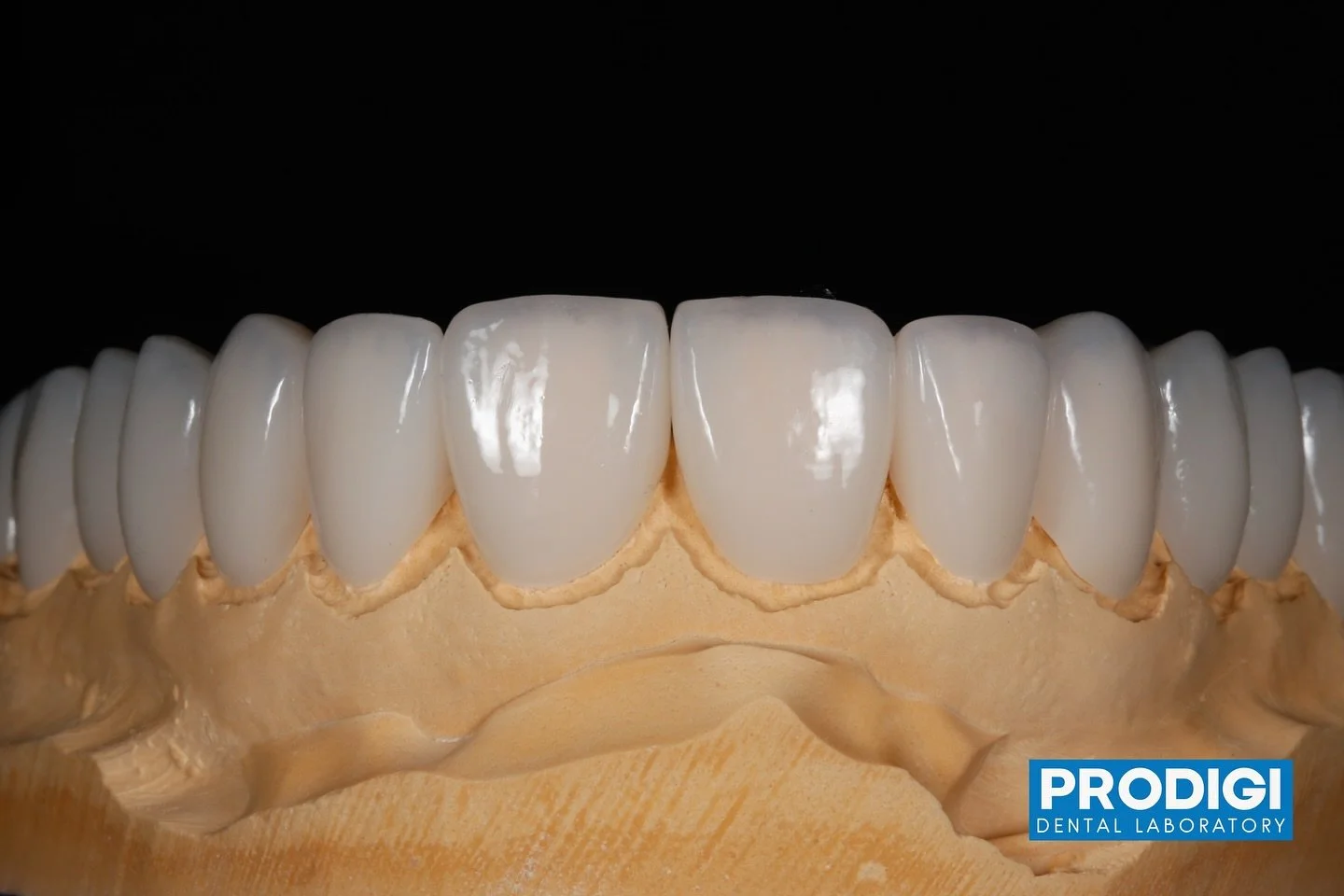 Ceramics for complete smile makeover.
With much love ❤️
@prodigi_dentallab