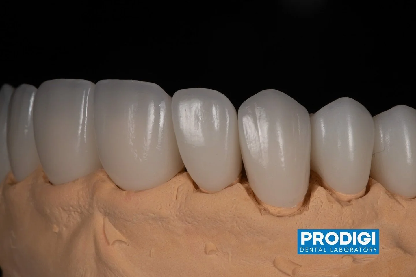 Full mouth rehab case ready for delivery with @dr_djshin