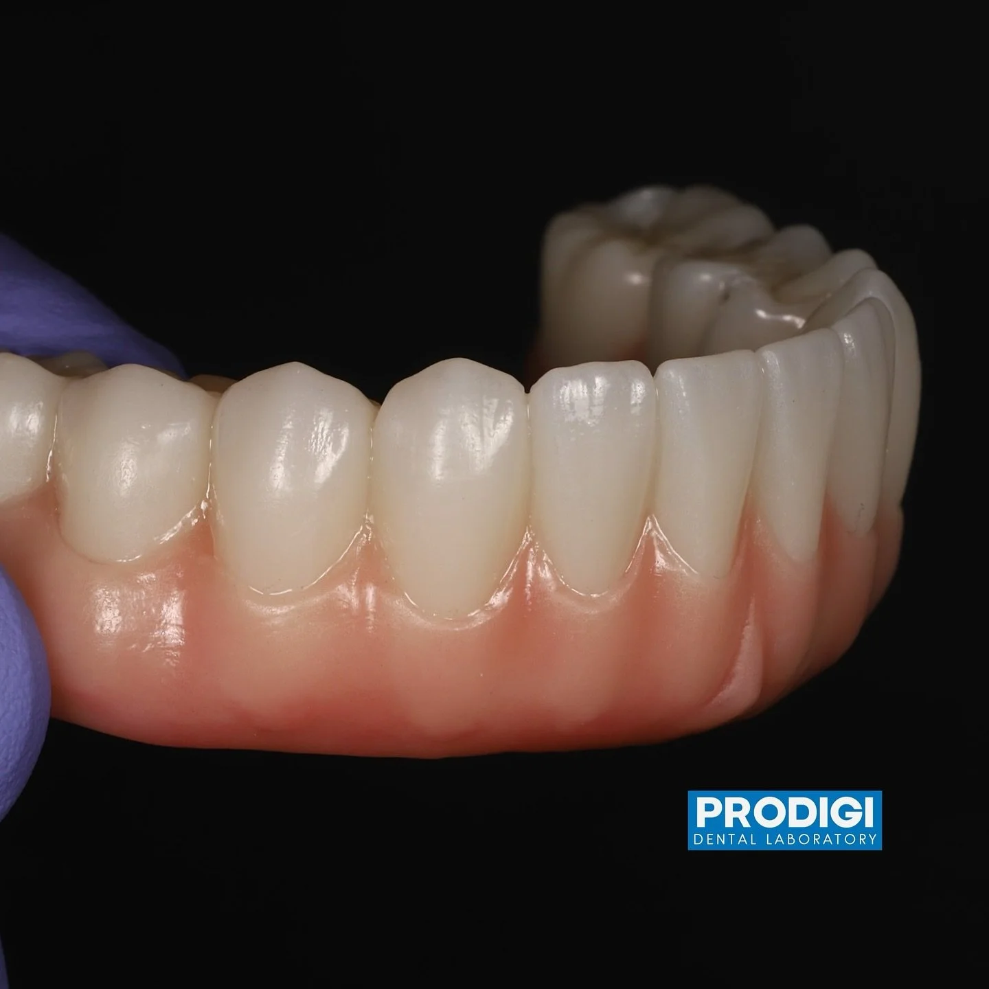 Mandibular all-on-X using digital workflow for best efficiency for our partnering doctors. 👍
@prodigi_dentallab