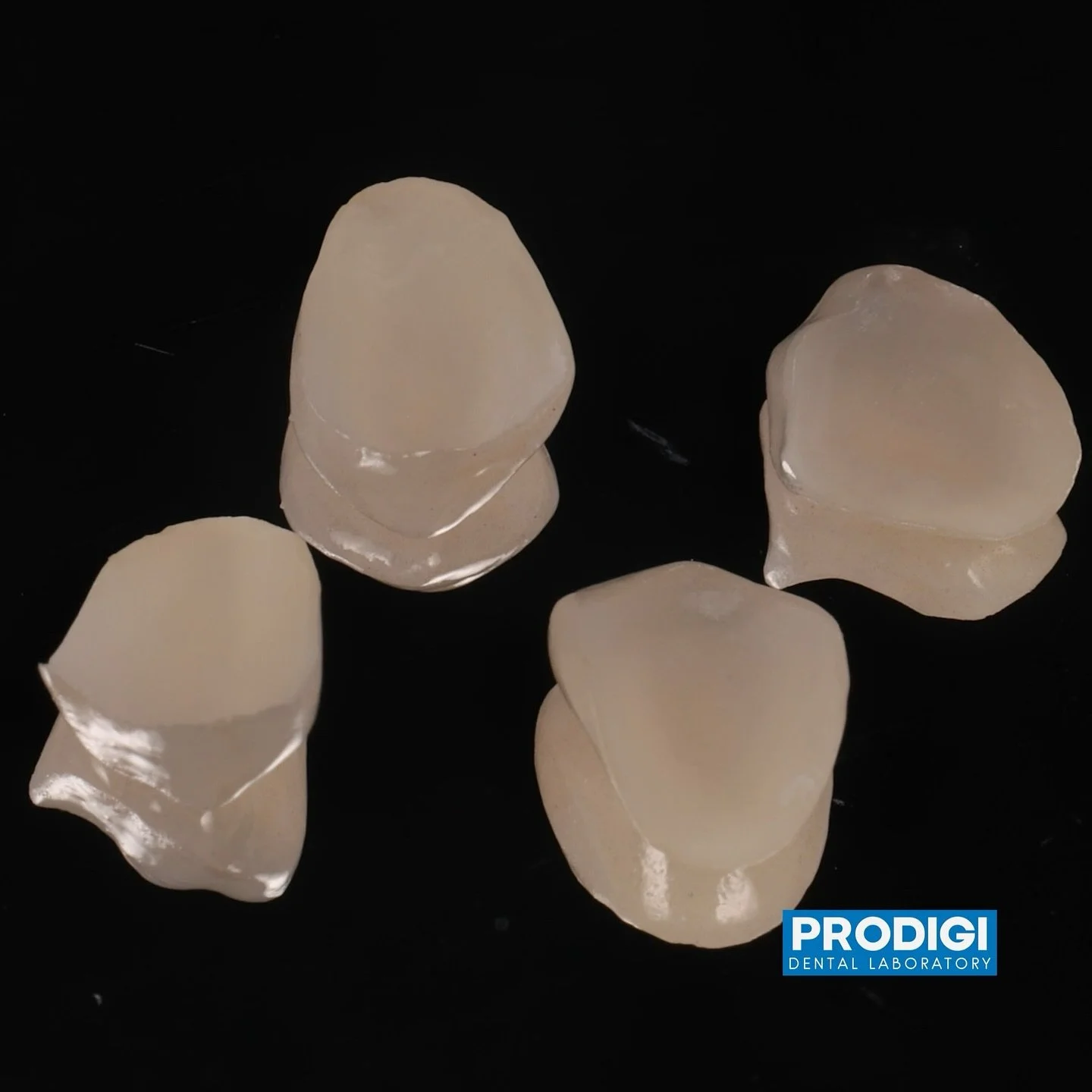 Intaglio LiSi treated Zirconia veneers.
To get the best of characteristics of both worlds - zirconia and Lithium disilicate:
✅Bonding strength of Lithium Disilicate
✅High ceramic strength of zirconia
✅Less tooth reduction required compared to Lit