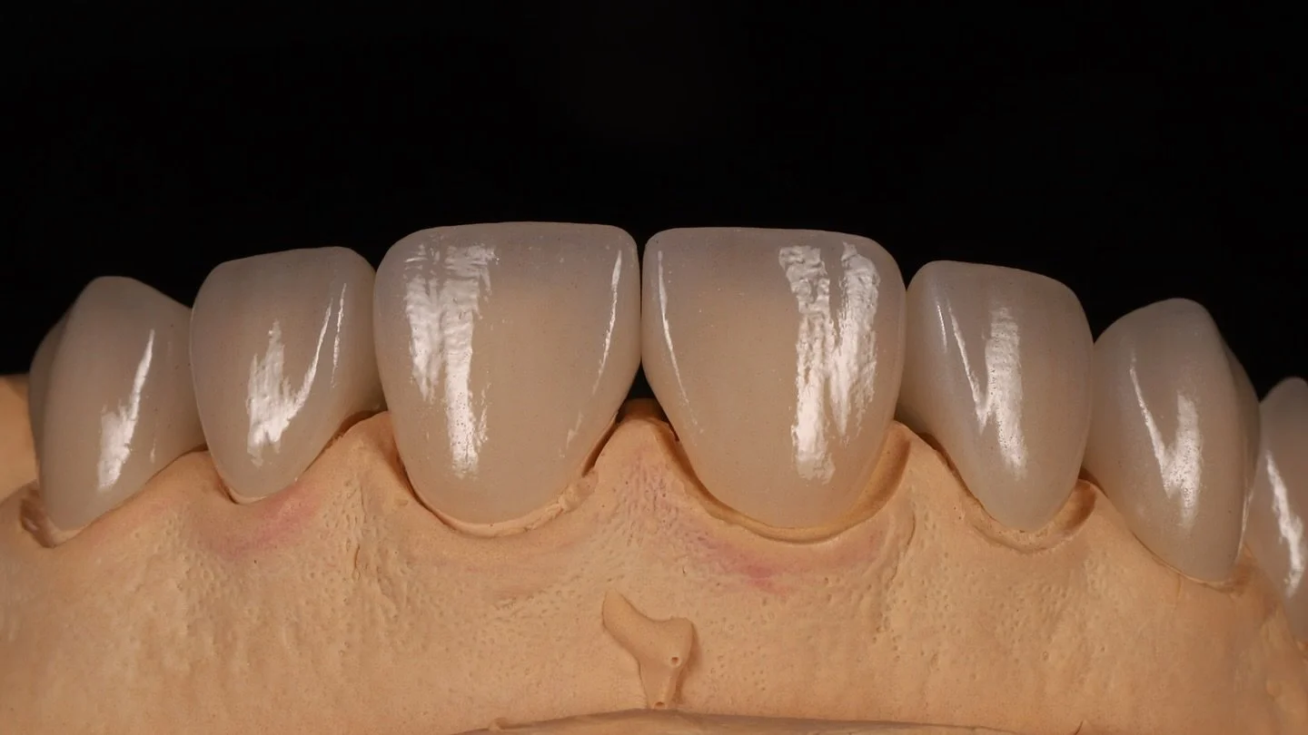Veneer work for maxillary arch.
@prodigi_dentallab