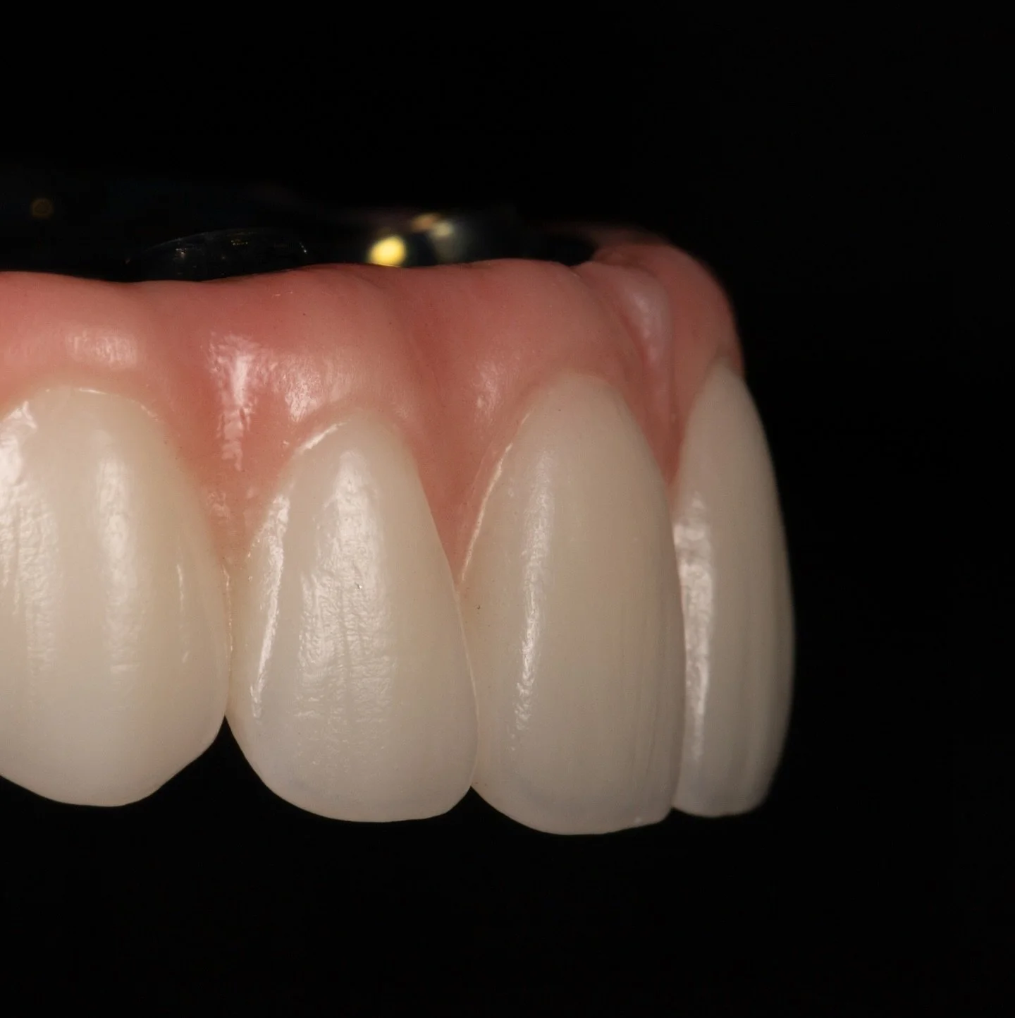 All-on-X prosthetic 
Titanium bar reinforced 
@prodigi_dentallab