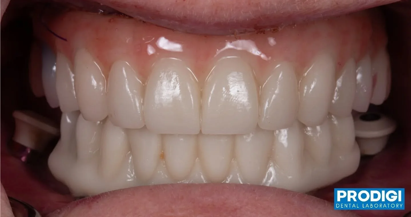 Same-day transformation 🙌
Old All-on-X removed, new implants placed, and a brand-new smile delivered &mdash; all in one day!
Precision, planning, and teamwork make full-arch restorations like this possible 💪
#AllOnX #DentalImplants #FullArch #SameD