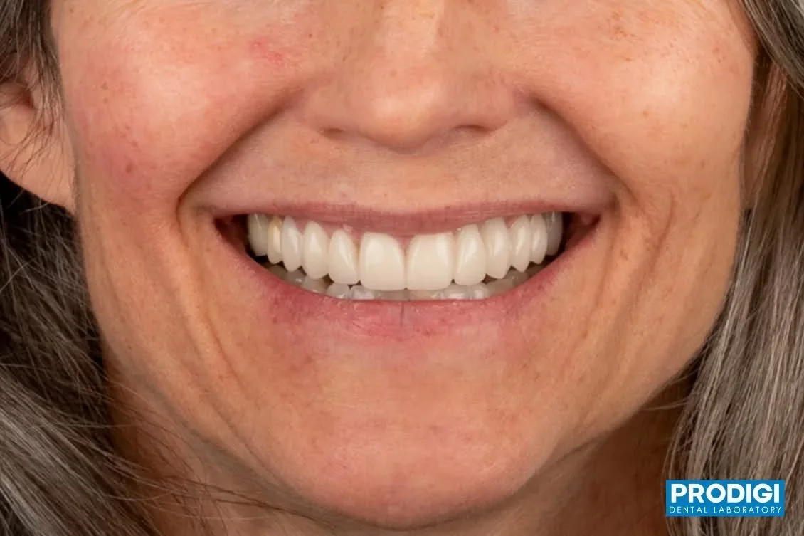 Upgrading this smile one step at a time ✨
Old maxillary temps replaced with new, better-contoured temporaries for improved esthetics and comfort and be ready for the final restoration soon.
#SmileTransformation #TempCrowns #ProsthoEndo #ProdigiDental