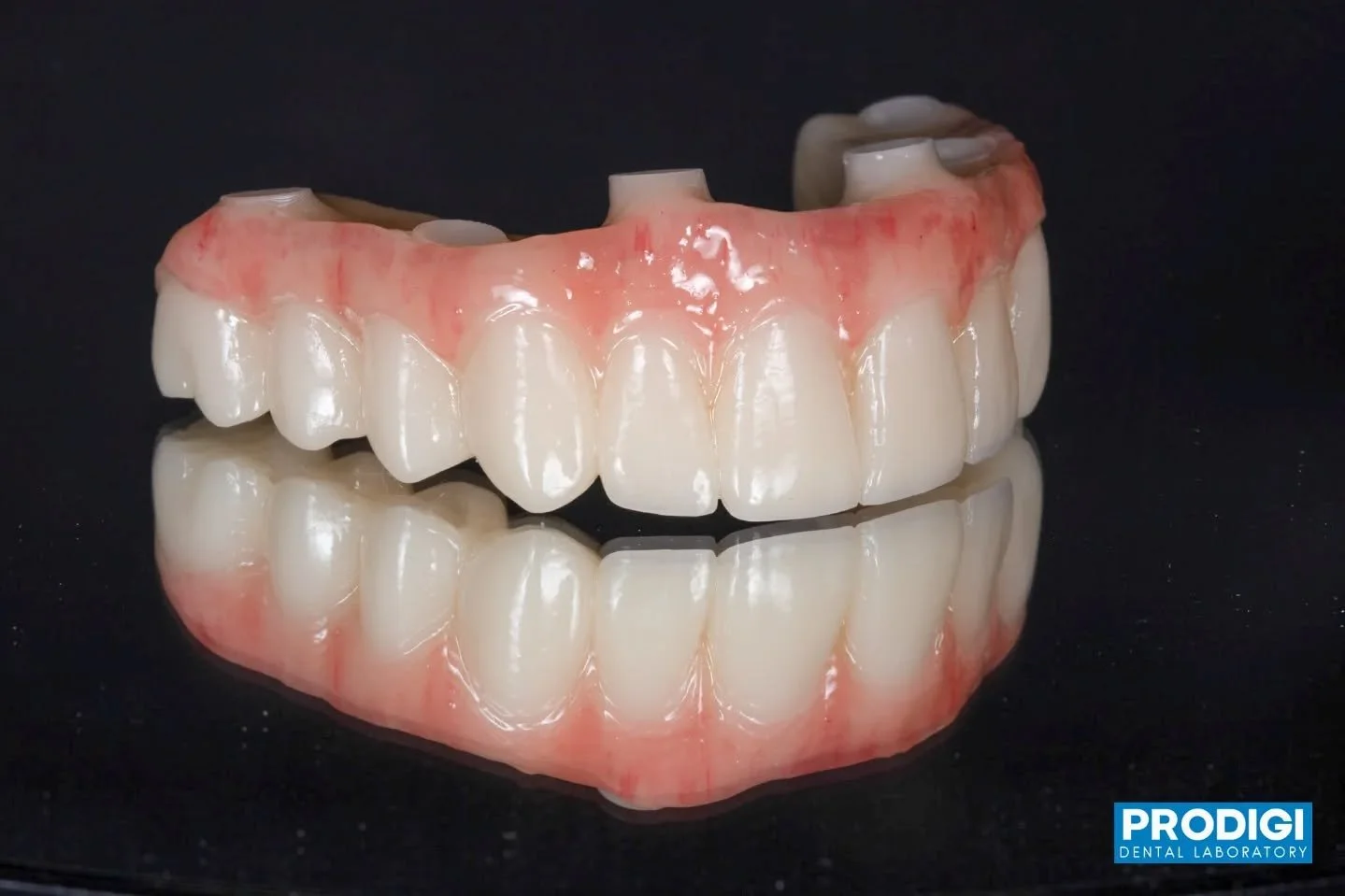 Maxillary All-on-X temporary &mdash; balancing function, esthetics, and patient comfort from the start 💪
#AllOnX #ImplantRehab #Prosthodontics #FullArchSmile #ProdigiDentalLab