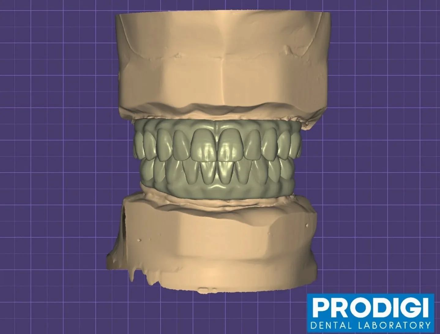 Full-mouth All-on-X designs &mdash; upper and lower arches digitally engineered for precision, symmetry, and esthetics ✨
#AllOnX #FullArchDesign #DigitalWorkflow #ImplantDentistry #SmileRehab #ProdigiDentalLab