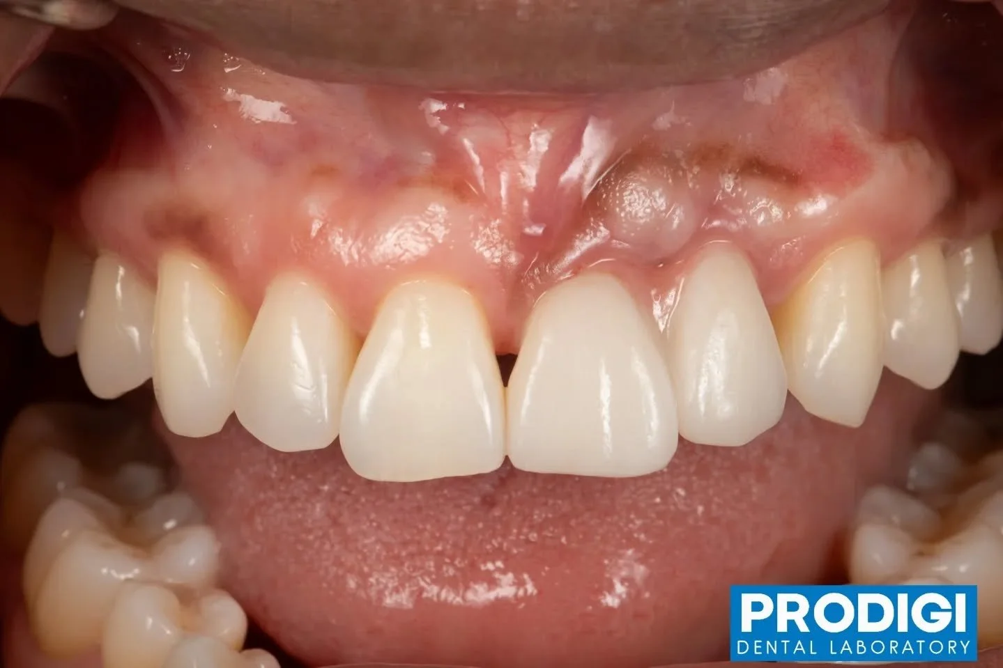 Anterior implant crowns with pink porcelain &mdash; precision-engineered for ideal emergence profile, soft tissue support, and natural esthetics 🦷✨
#ImplantDentistry #CustomAbutment #AnteriorEsthetics #Prosthodontics #DigitalWorkflow #ProdigiDentalL