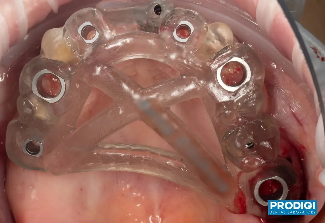 Precision meets stability in guided surgery 🦷
This screw-retained surgical guide was designed to utilize the patient&rsquo;s existing implants and prepped teeth for maximum accuracy and control during placement.

In this case, two existing implants 