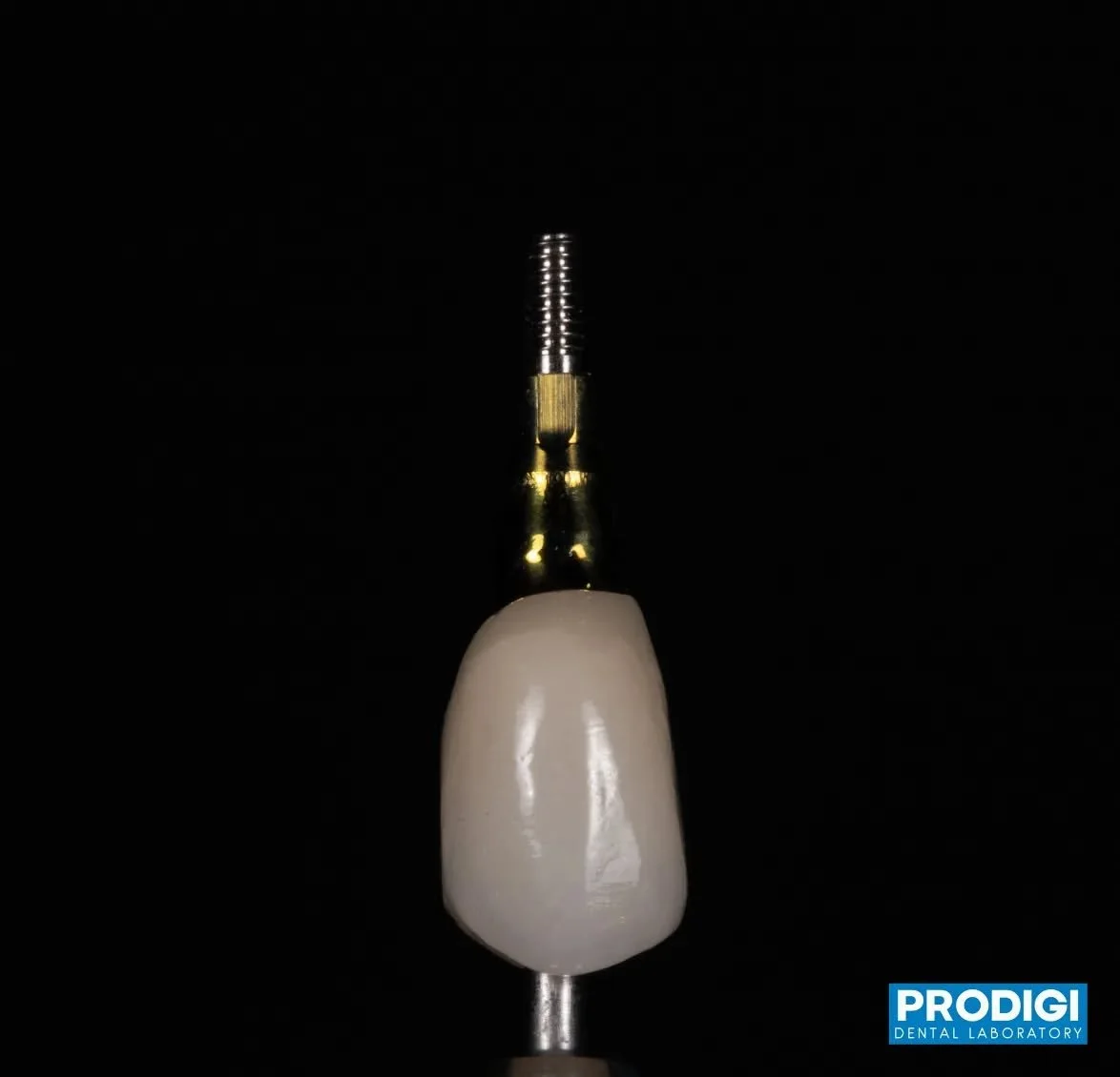 Custom abutments + screw-retained crowns = precision, strength, and esthetics 👌
Digitally designed for a perfect fit and long-term stability.
#ImplantRestoration #ScrewRetained #CustomAbutment #DigitalDentistry #ProdigiDentalLab