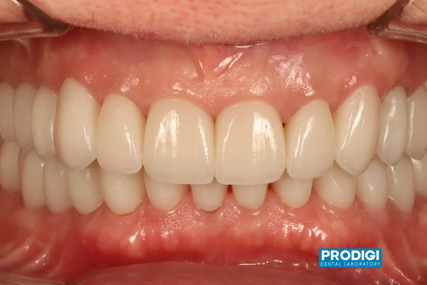 New smile. New confidence ✨
A complete full mouth restoration designed to bring back comfort, function, and beauty.
#SmileRehab #FullMouthRestoration #DentalImplants #Prosthodontics #ProdigiDentalLab