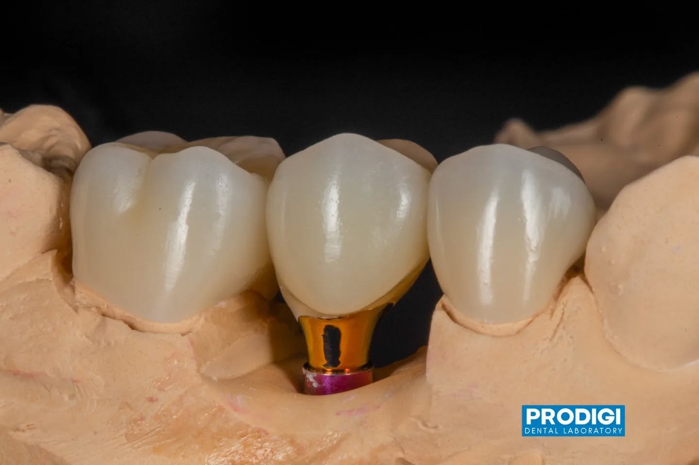 Crowns and screw-retained crowns with custom abutments &mdash; precision fit, natural esthetics, and long-term durability 🦷✨
#ImplantDentistry #CustomAbutment #ScrewRetained #DentalCrowns #DigitalDentistry #ProdigiDentalLab