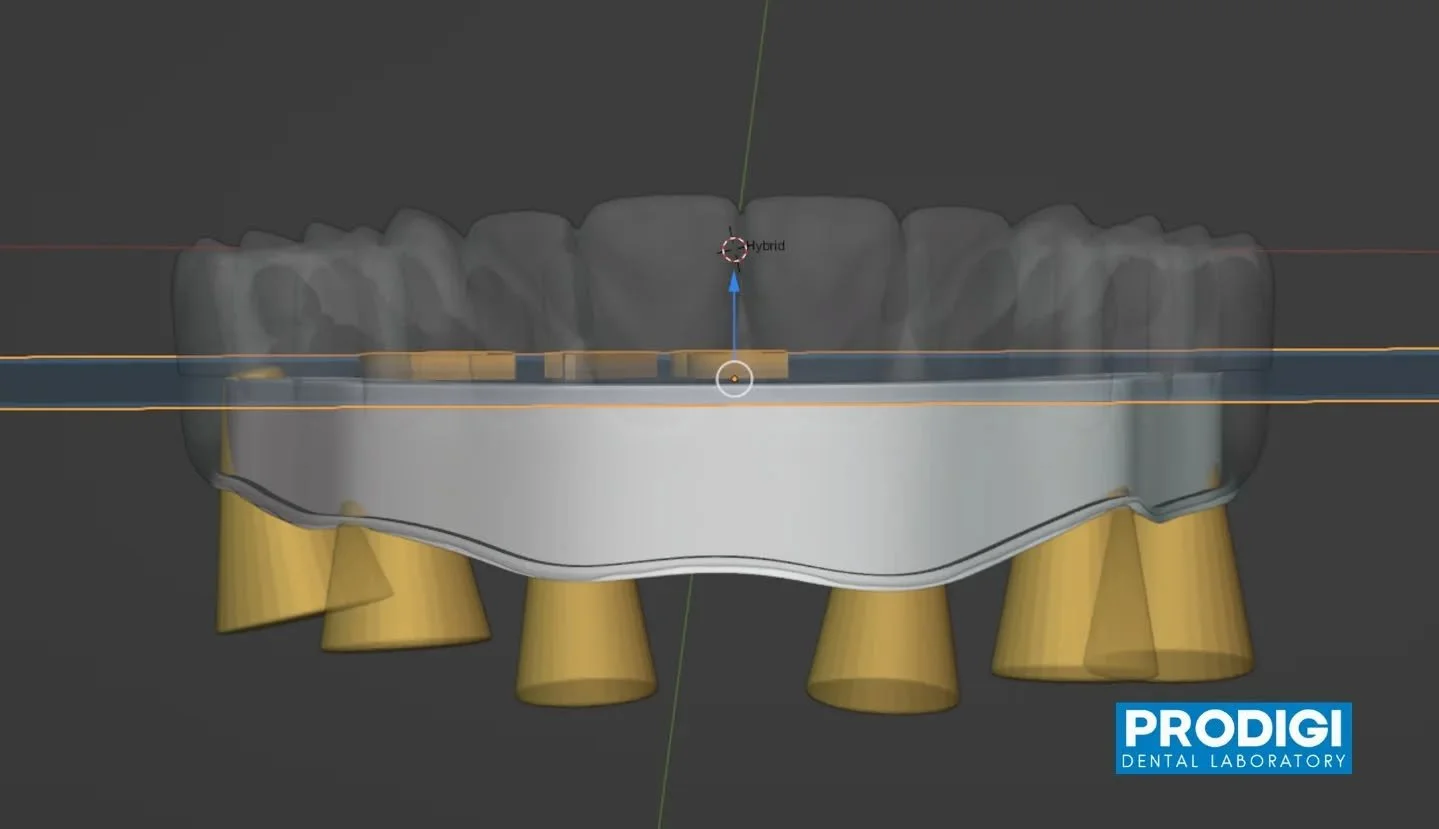 I-bar framework design for full-arch All-on-X restoration 🔩
Engineered for optimal strength, passivity, and hygiene access while maintaining a lightweight, precise fit.
#AllOnX #IBarDesign #FullArchRehab #ImplantDentistry #DigitalWorkflow #ProdigiDe
