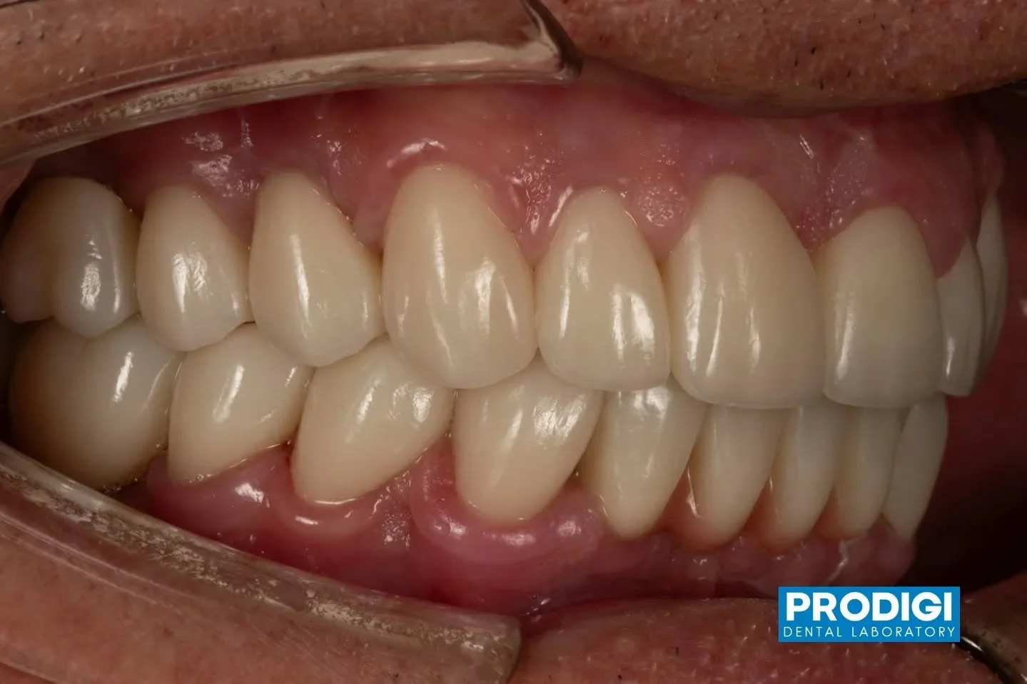 Strength in the core, beauty in the details ✨
Full-arch zirconia crowns elevated with micro-layering to mimic natural enamel and depth.
#DentalArtistry #ZirconiaRestoration #MicroLayering #FullMouthRehab #ProdigiDentalLab
