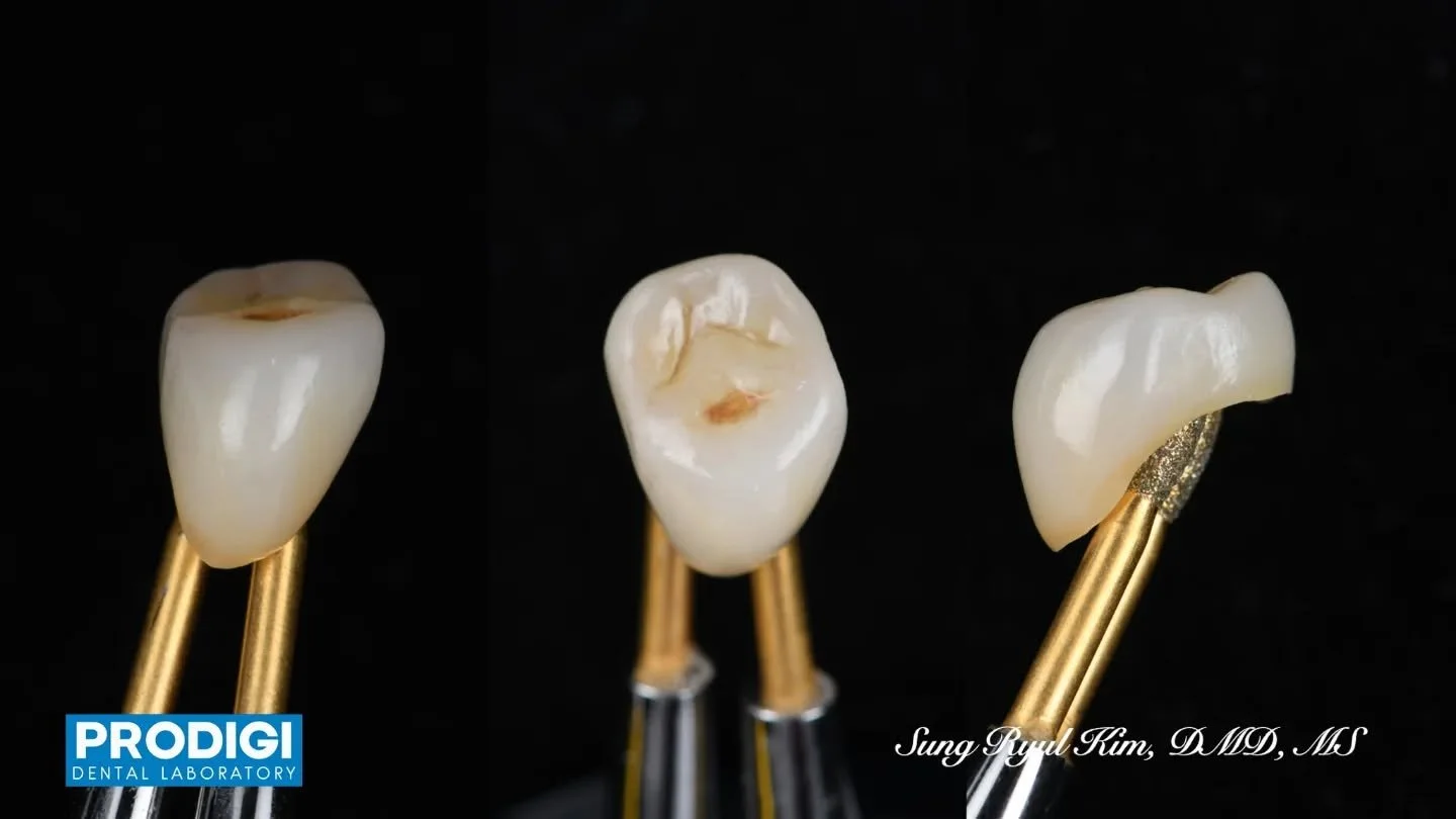 Precision-crafted monolithic zirconia crown in collaboration with Dr. Sung Ryul Kim ✨
Designed for durability, fit, and natural esthetics.
#MonolithicZirconia #DentalRestoration #ProdigiDentalLab