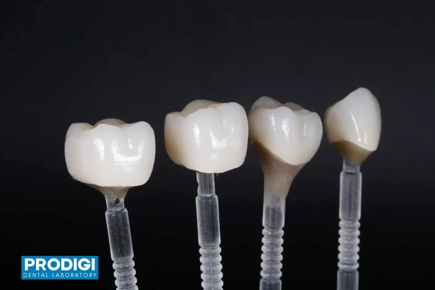 Challenging case with a dark stump shade, but the patient requested bright, translucent esthetics ✨
Through strategic cutback and ceramic buildup, we achieved natural brightness while maintaining depth and translucency.
#DentalCeramics #CutbackTechni