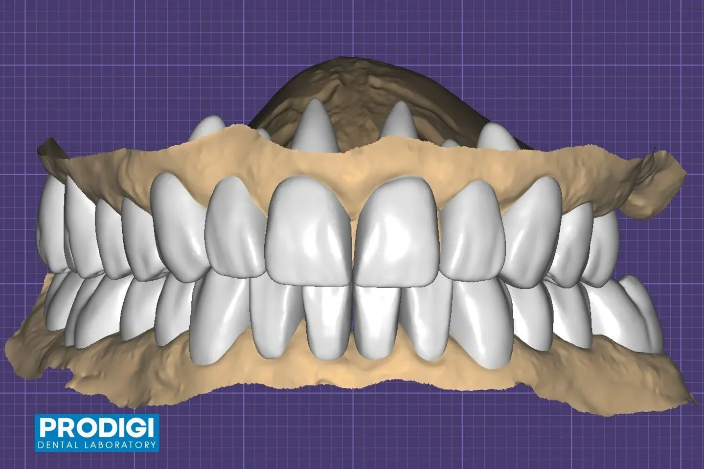 Full mouth restoration following the KOIS treatment principles, in collaboration with Livewell Dental 🦷
A comprehensive approach focused on function, occlusion, esthetics, and long-term predictability. @livewelldentalva @chriskim.dds
#KOIS #FullMout
