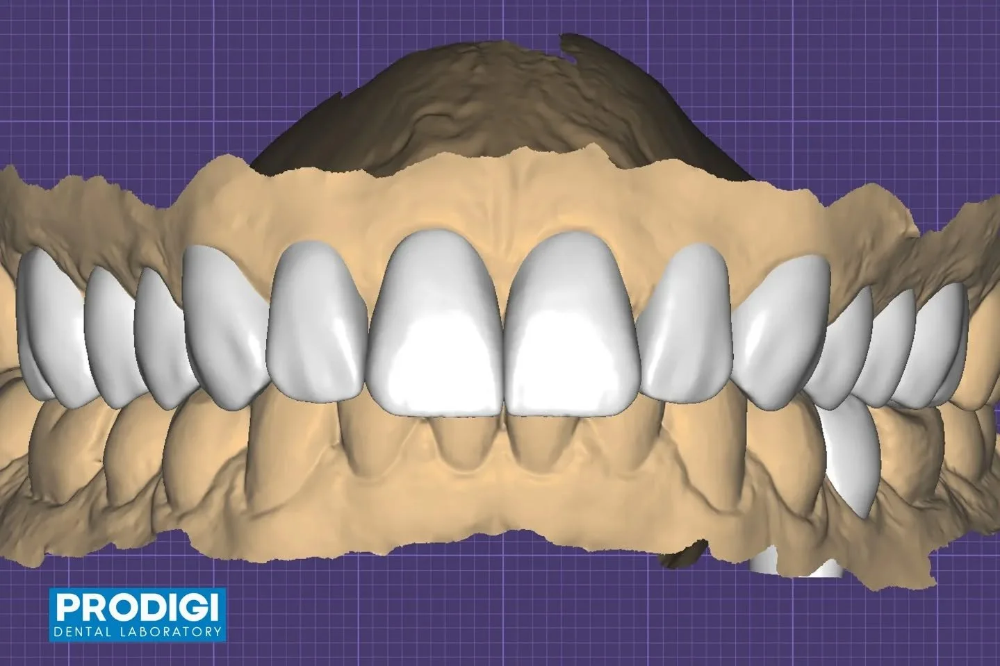 Maxillary arch diagnostic wax-up and provisional crowns completed following KOIS treatment principles 🦷
Designed to evaluate esthetics, occlusion, and function before moving to the final restorations.
A critical step in predictable, long-term succes