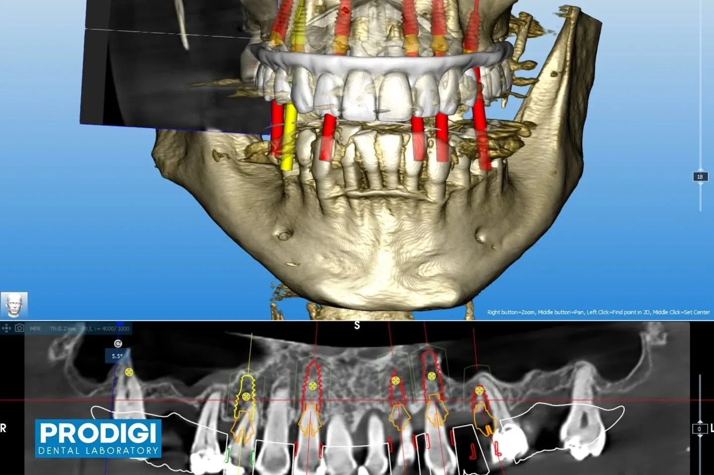 Maxillary surgical guide designed in RealGuide for precise placement of six implants, followed by immediate loading with a temporary bridge and denture 🦷
A fully guided workflow ensuring accuracy, stability, and same-day function.
#RealGuide #Surgic