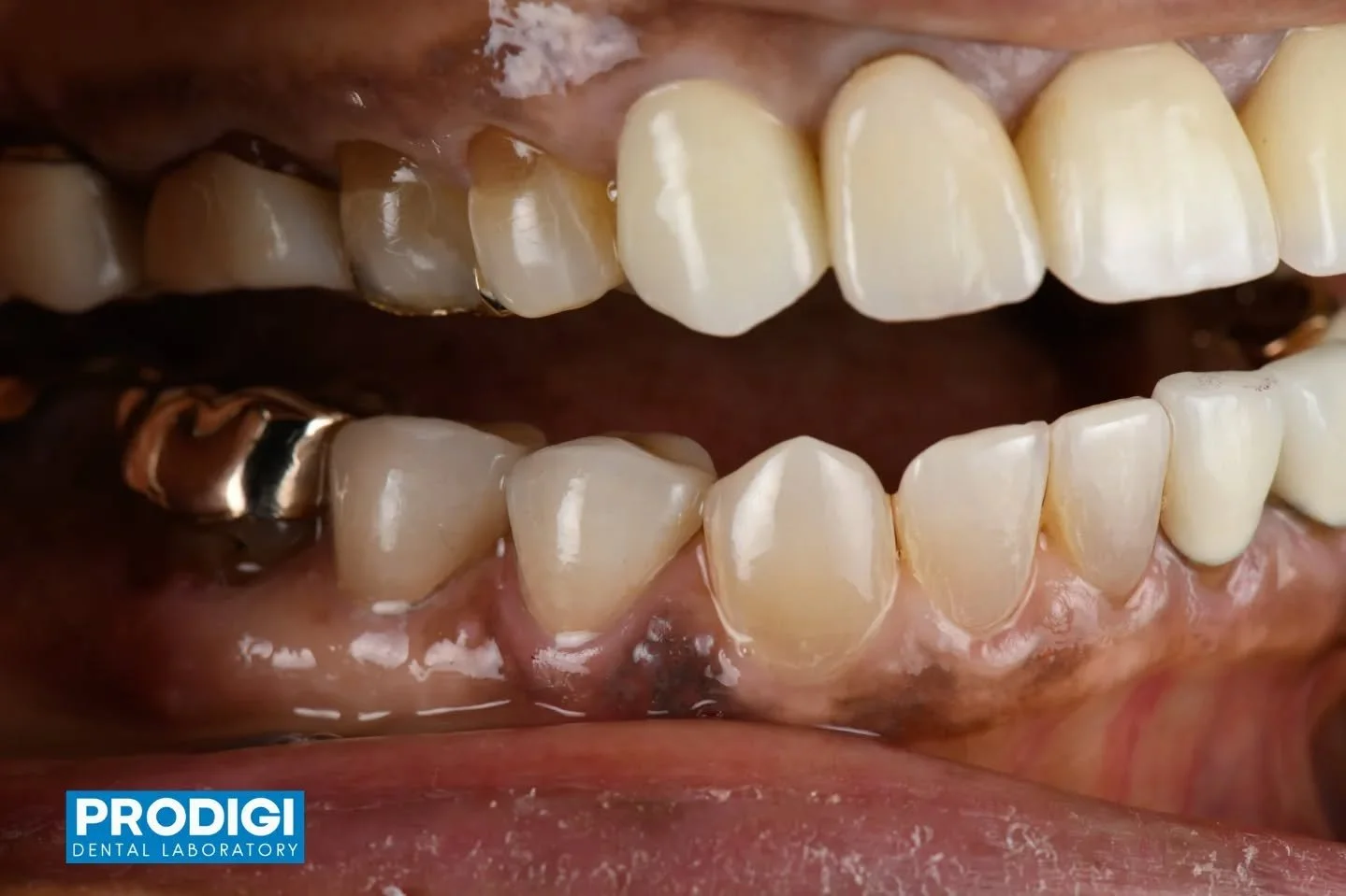 Precision-milled monolithic zirconia crowns for predictable fit and durability ✨ @steven.eom_dds
#MonolithicZirconia #DigitalWorkflow #ProdigiDentalLab