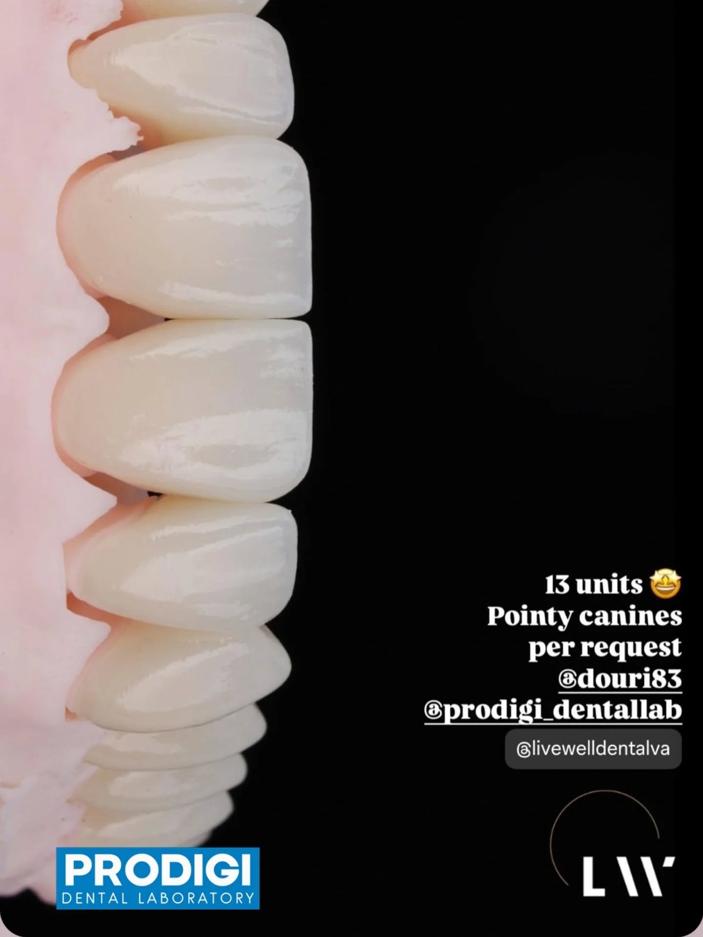 Crowns completed following KOIS principles, in collaboration with Dr. Chris Kim 🦷
Designed for predictable function, esthetics, and long-term success.

@chriskim.dds

#KOIS #Prosthodontics #livewelldentalva #ProdigiDentalLab