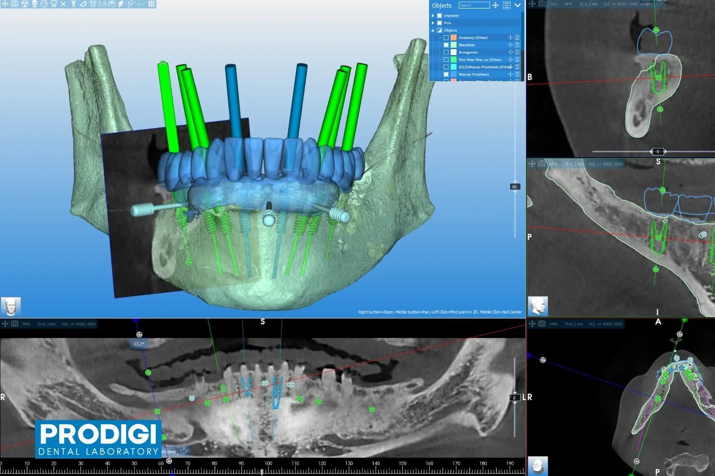 Mandibular full-arch surgical guide designed in RealGuide for precise placement of 8  implants 🦷
Engineered for accuracy, stability, and predictable full-arch outcomes.
#RealGuide #SurgicalGuide #FullArchImplants #ImplantDentistry #ProdigiDentalLab