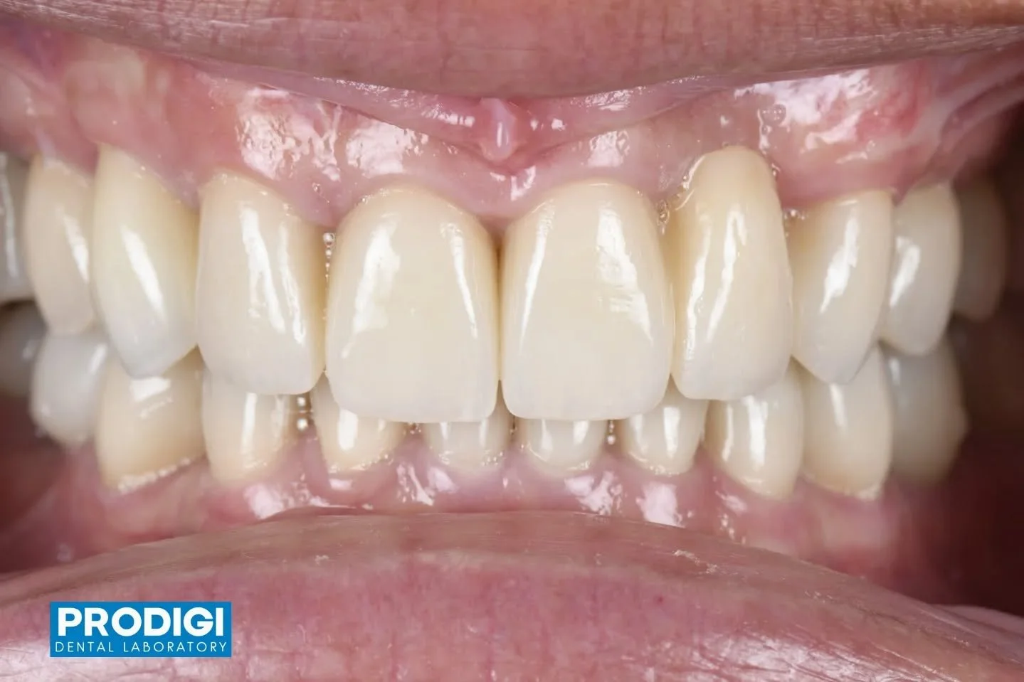 Digitally designed single-unit anterior screw-retained crown for optimal angulation, tissue support, and esthetic harmony. @steven.eom_dds
#ImplantProsthetics #AnteriorImplant #DigitalWorkflow #ProdigiDentalLab