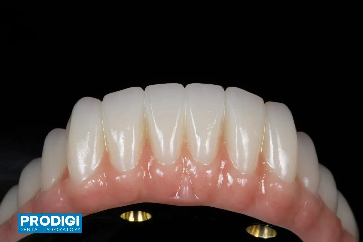 Full mandibular All-on-X supported by a custom titanium I-bar 🔩🦷
Engineered for strength, passive fit, and long-term stability &mdash; delivering predictable full-arch function and esthetics.
#AllOnX #iBar #FullArchRehab #DOF #ProdigiDentalLab