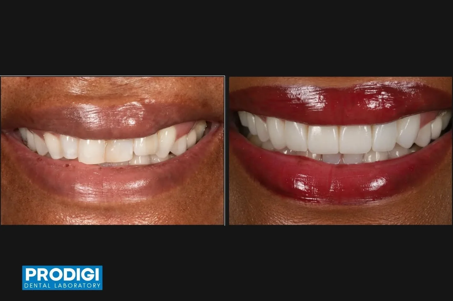 Maxillary anterior case integrating veneer, crown, and implant restoration &mdash; carefully matched for shade, contour, and tissue harmony.
Precision planning for predictable esthetics.

@dr_djshin @prostho.dental

#ImplantProsthetics #Veneers #Ante
