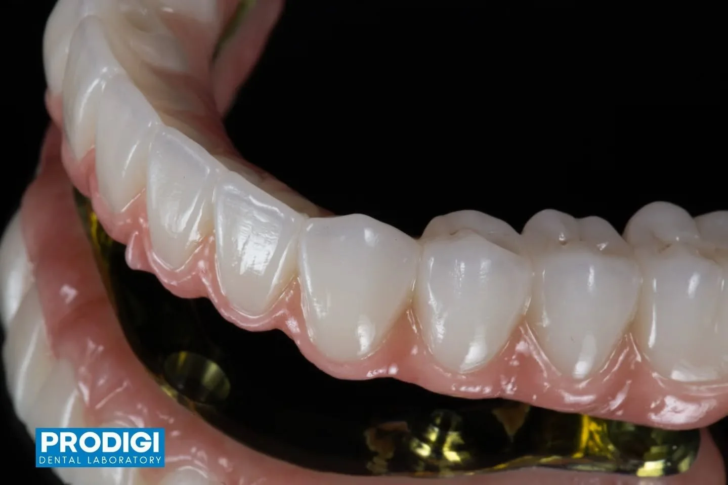 Full mandibular All-on-X supported by a custom titanium I-bar 🔩🦷
Engineered for strength, passive fit, and long-term stability &mdash; delivering predictable full-arch function and esthetics.
#AllOnX #iBar #FullArchRehab #ProdigiDentalLab