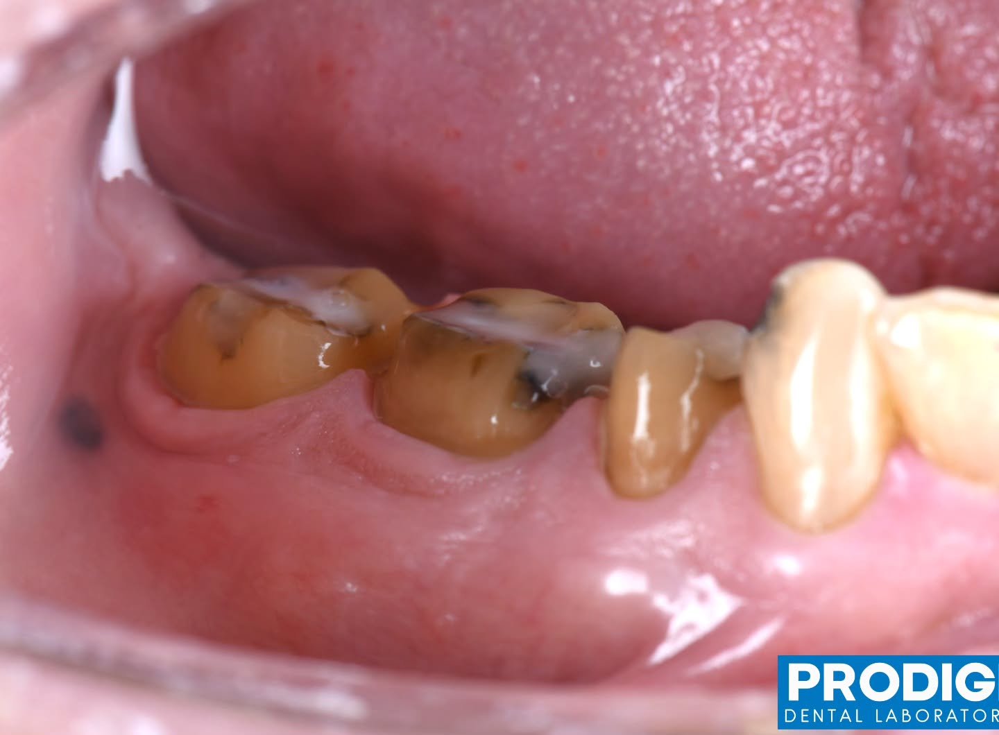 ​Seamless. Strong. Natural. 💎
​Check out this incredible shade match for our latest monolithic zirconia case. By matching the natural translucency and hue of the neighboring teeth, we&rsquo;ve created a restoration that is as beautiful as it is dura