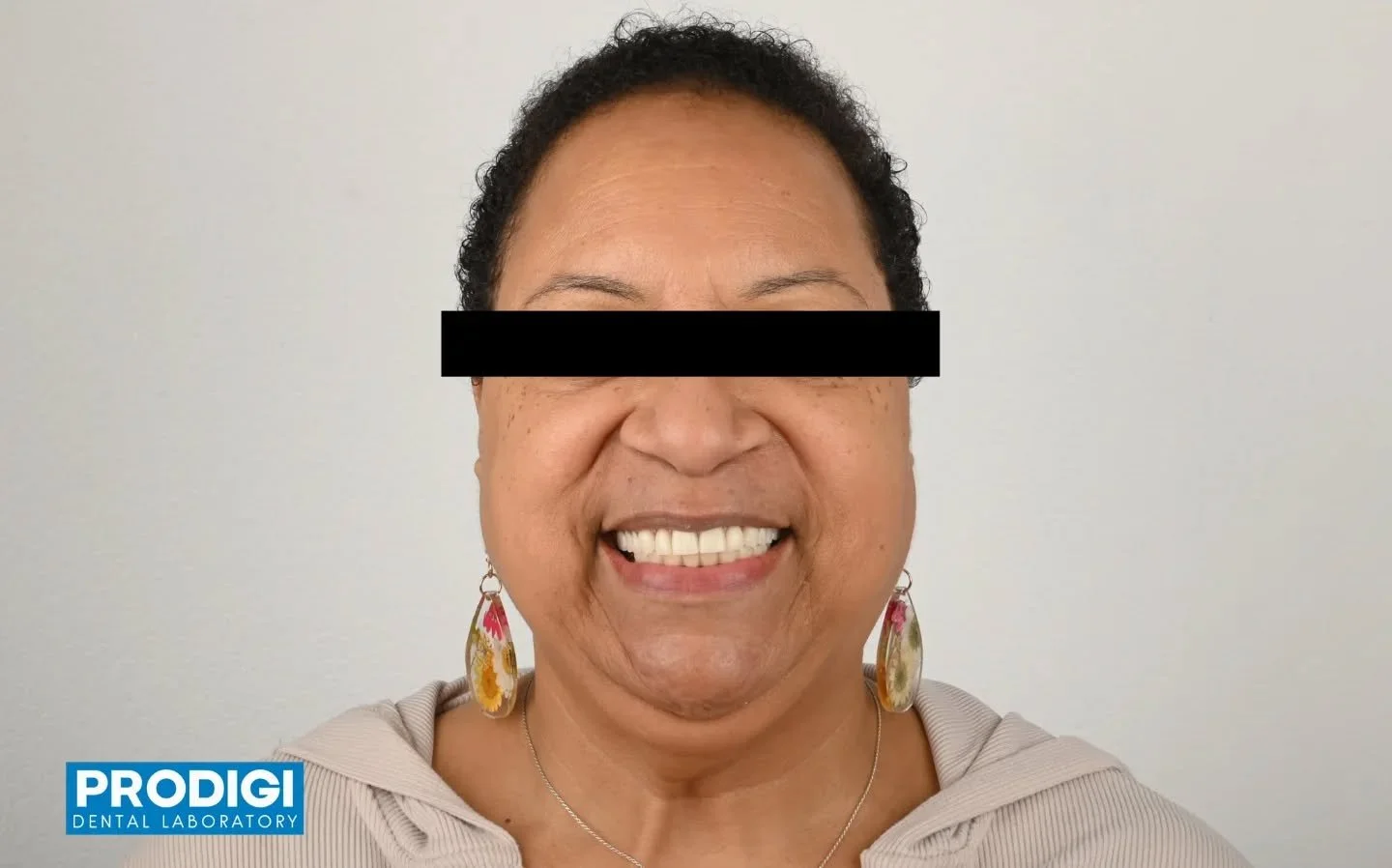 Comprehensive mandibular full-arch restoration &mdash; from plan to same-day provisional 🦷✨

This lower full-mouth case involved placement of 8 implants, beginning with a detailed diagnostic wax-up and temporary design, followed by precise digital s