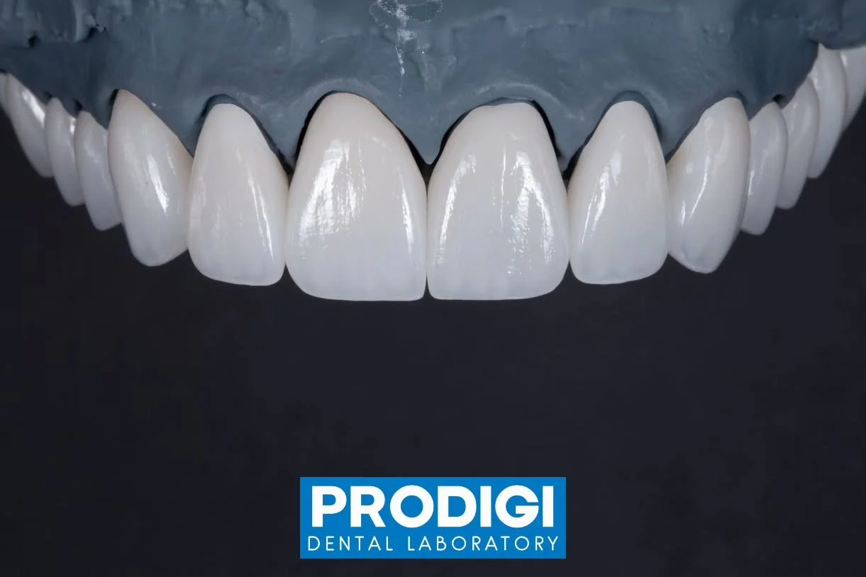 ​[From Diagnostic Wax-up to Final: Predictability You Can Trust]
​Are you tired of losing the precise details of your Diagnostic Wax-up by the time you reach the Final Restoration? At Prodigi Dental Lab, we specialize in bridging that gap.
​Our Full 
