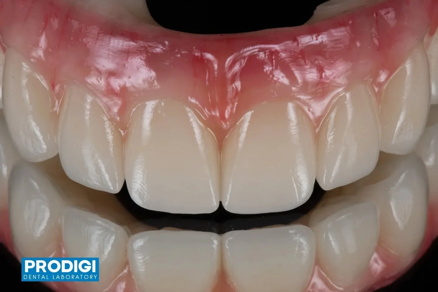 All-on-X temporary restoration printed with Rodin Titan, enhanced with ID Gum Flow for gingival characterization and finished with GC Optiglaze for natural esthetics and durability 🦷✨
A digital workflow delivering strength, precision, and lifelike d