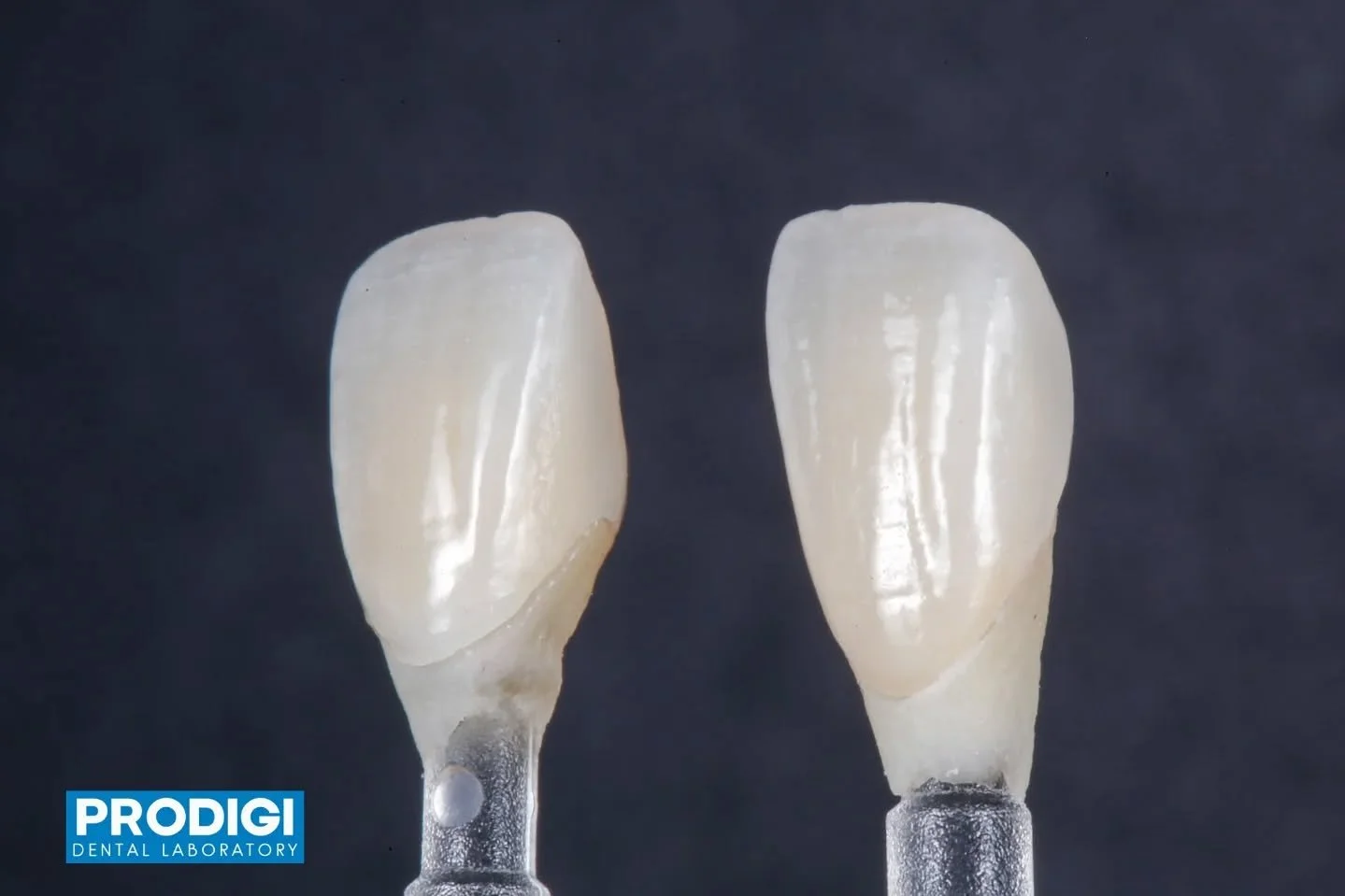 Two maxillary central incisors restored with precise eLab shade matching, enhanced with custom calcifications and natural surface textures for seamless integration.
Using Natural Die material to accurately reproduce the underlying tooth structure and