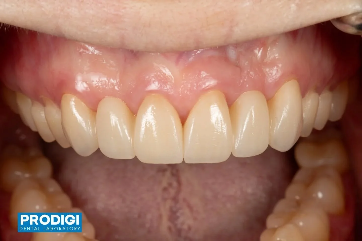 Maxillary anterior restorations with 3-unit bridges designed to restore esthetics, symmetry, and function 🦷✨
Carefully crafted to blend seamlessly with the natural smile.
#DentalRestoration #Prosthodontics #SmileDesign #DigitalDentistry #ProdigiDent
