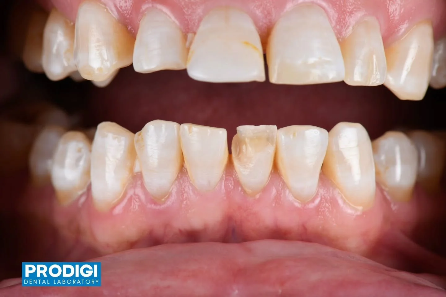 24 veneer crafted using the eLab Prime system to capture precise shade and value 🦷✨
Maximizing the underlying stump shade to achieve natural depth, translucency, and seamless integration.

@steven.eom_dds

#eLabPrime #ivoclar #hassamber #prodigident