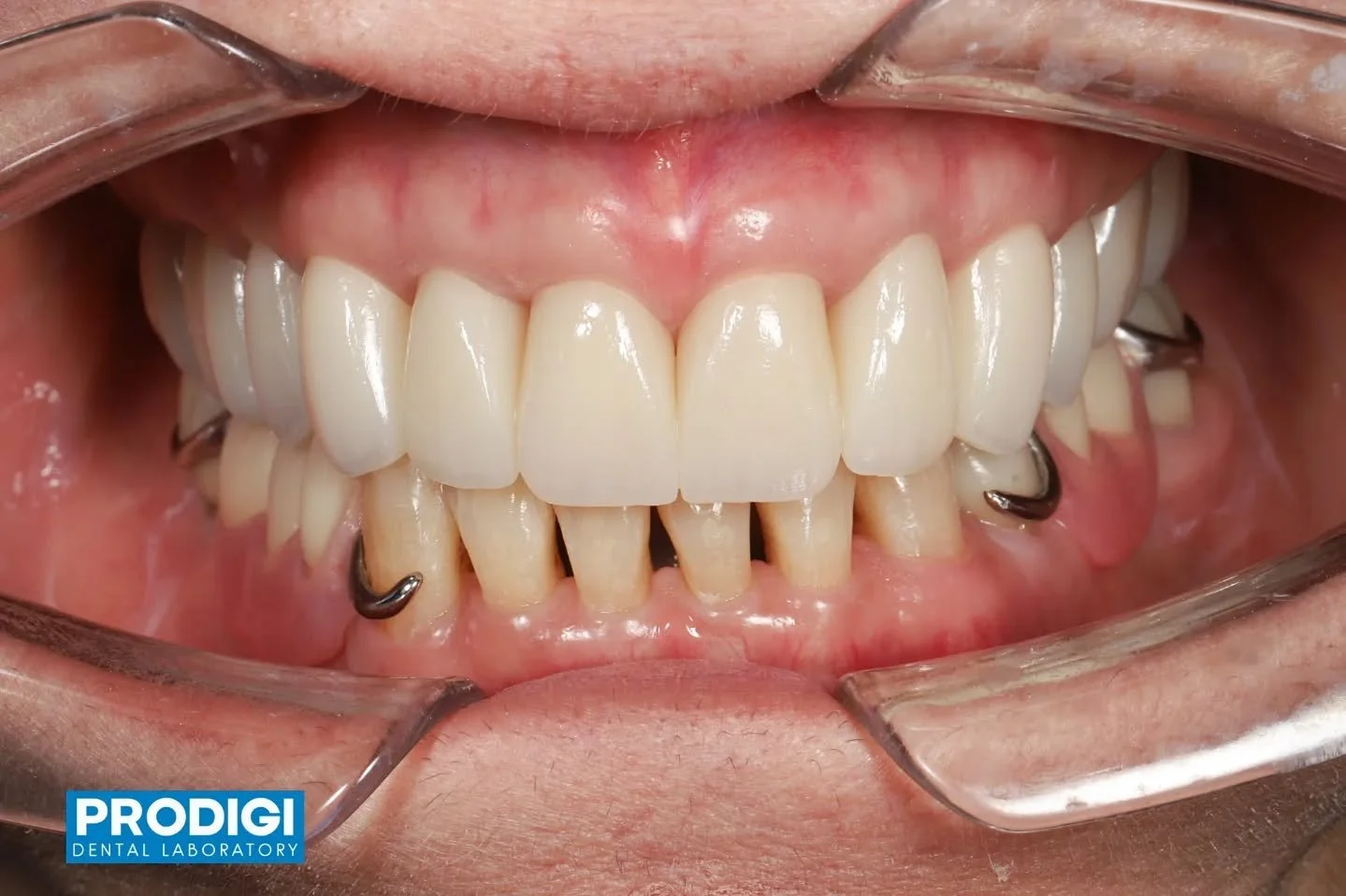 Restoring stability, function, and comfort 🦷✨

This case involved a comprehensive rehabilitation of both arches.
For the lower arch, existing implant crowns were replaced and survey crowns were fabricated to support a removable partial denture.

For