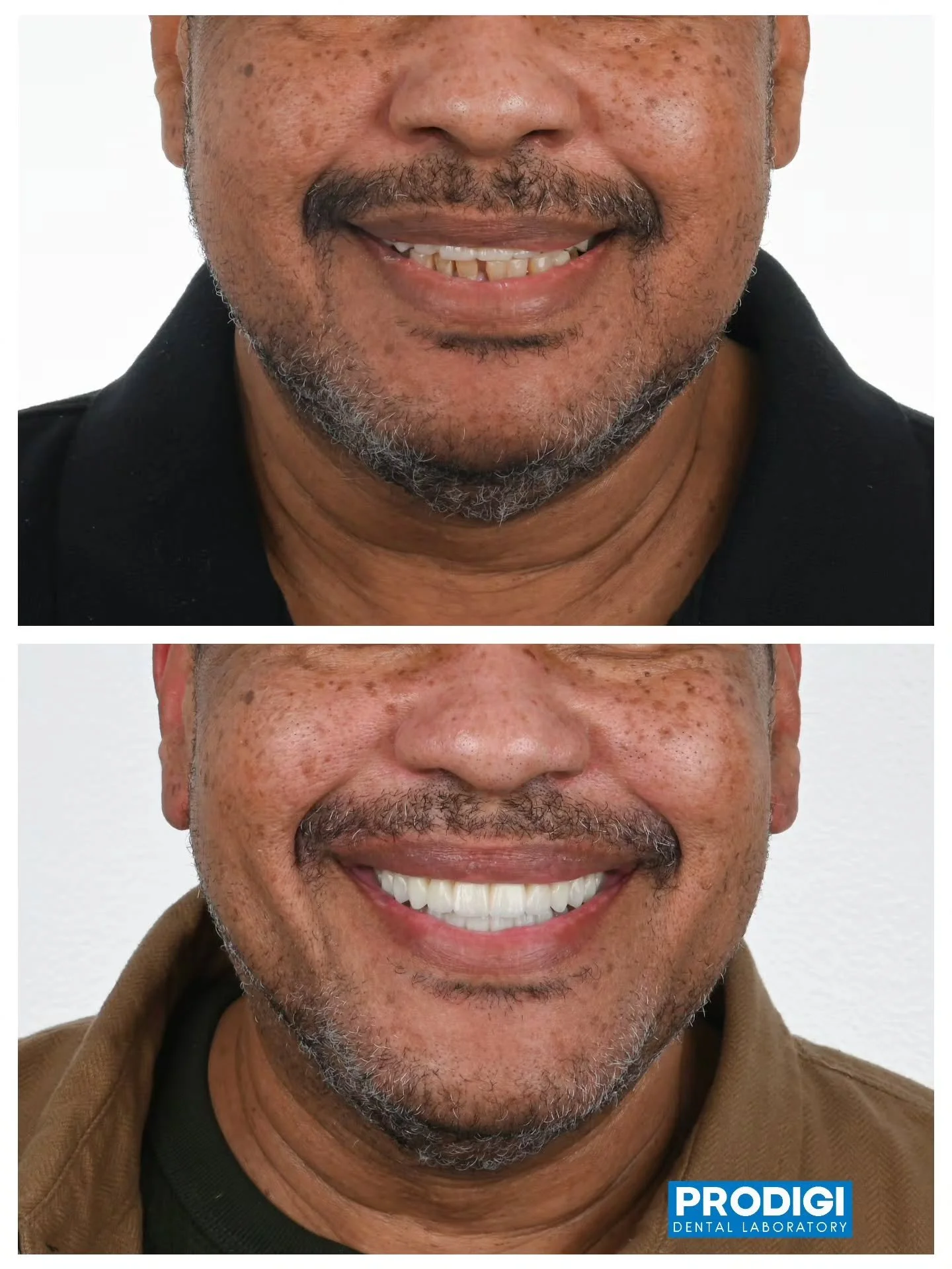 ​"New Smile. New Life. All-on-X isn't just a dental procedure&mdash;it's a turning point. Witness the incredible power of a functional, beautiful transformation. The confidence speaks for itself."

@steven.eom_dds 

@prostho.dental

#allonx