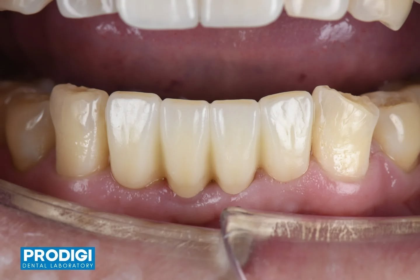 4-unit implant-supported bridge developed through careful tissue molding with temporaries to achieve ideal soft tissue contours 🦷✨
Finalized in monolithic zirconia, allowing natural material properties to define the esthetics.
Precision in both tiss