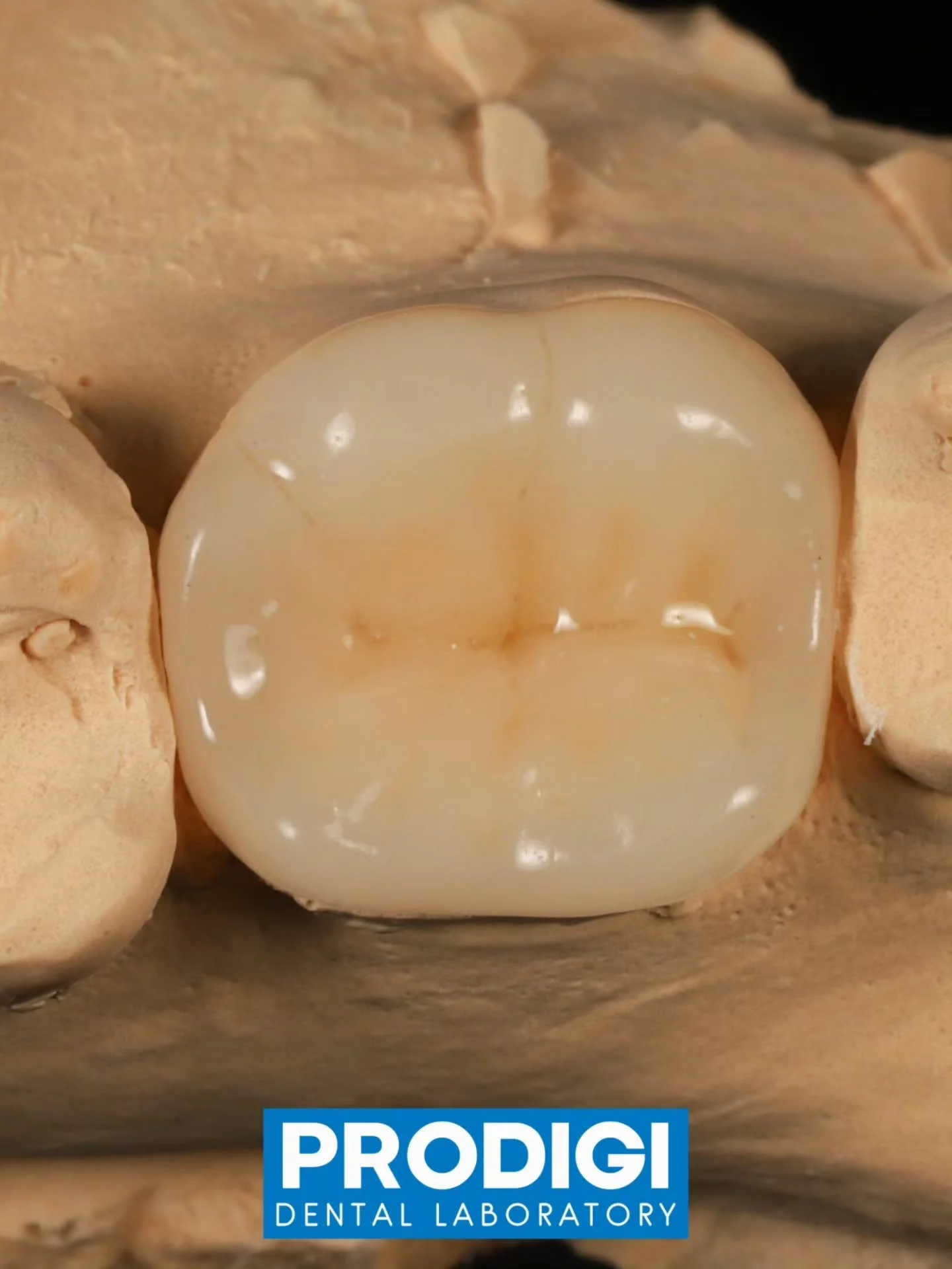 ​The Science Behind perfect Overlays: Vita Enamic Demystified 🔬

​Have you wondered what gives Vita Enamic its incredible properties? We're diving into the precise composition of this revolutionary hybrid material:

​🔬 The Dual-Network Structure: V