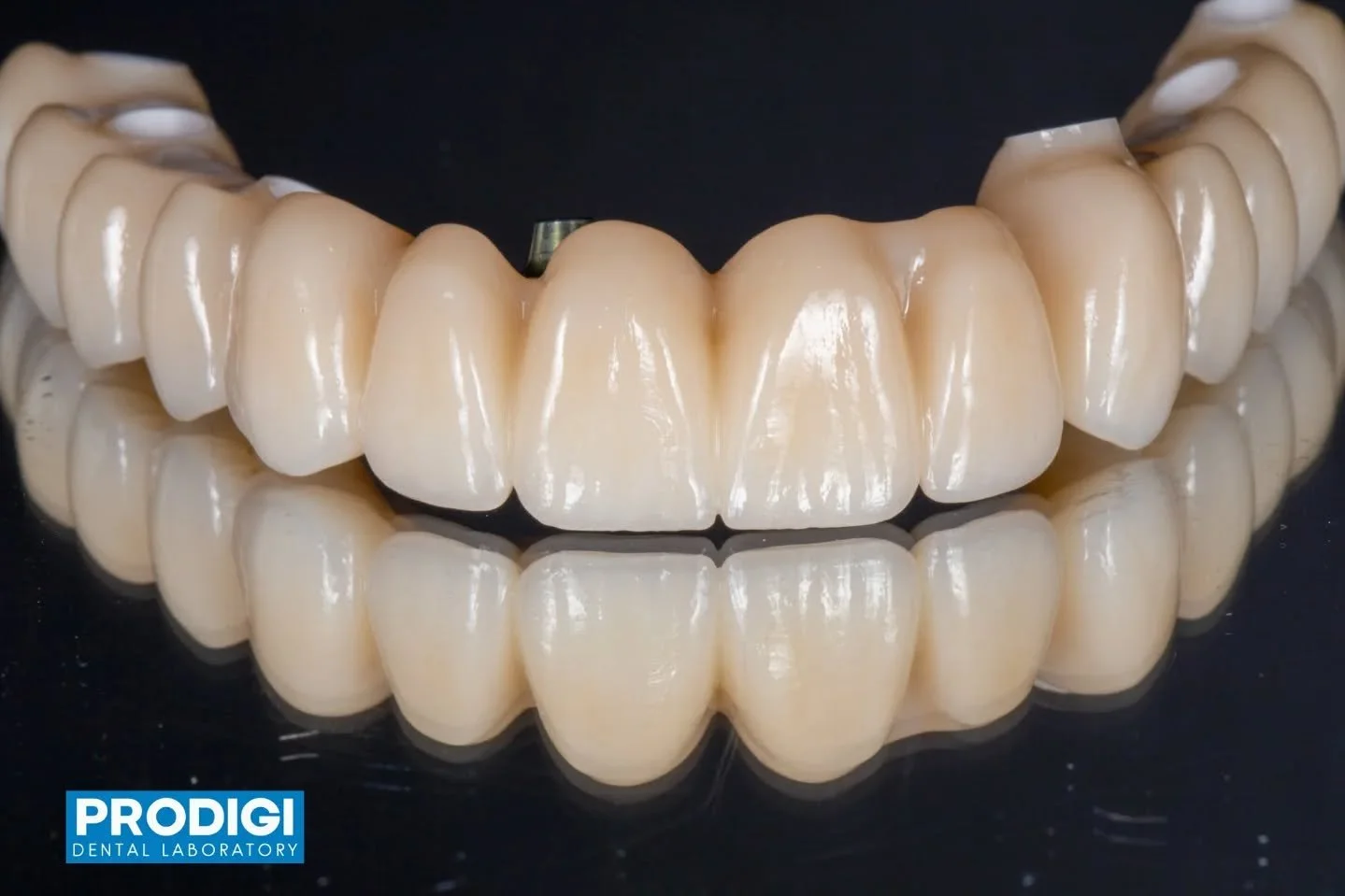 FP1 zirconia bridges designed with a hybrid approach &mdash; one bone-level implant and the remaining supported via MUA direct-screw 🔩🦷
Segmented into 3 pieces to allow passive fit and stress relief, enhancing long-term stability and predictability