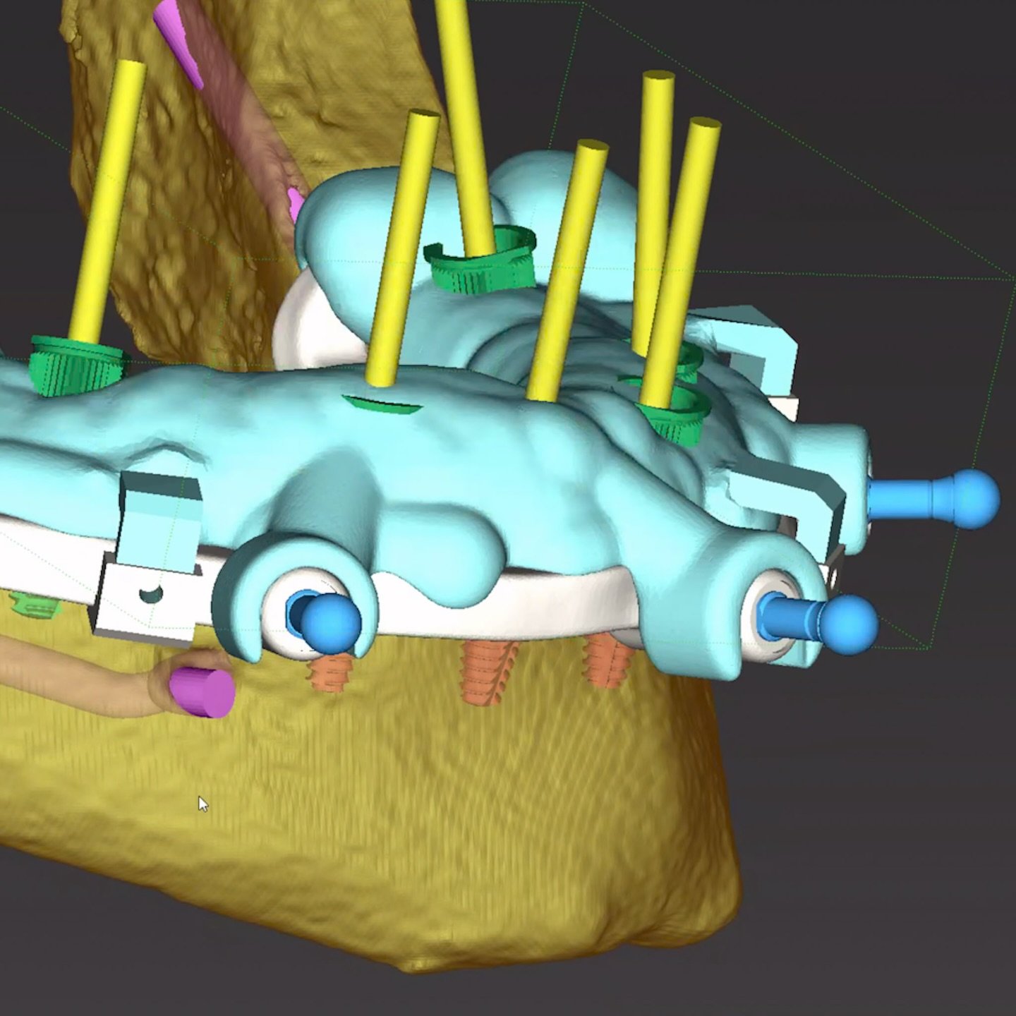Prosthetically guided surgical work for our partnering surgeons. 
Stackable guide for mandibular all-on-X prosthetics. 
@prodigi_dentallab