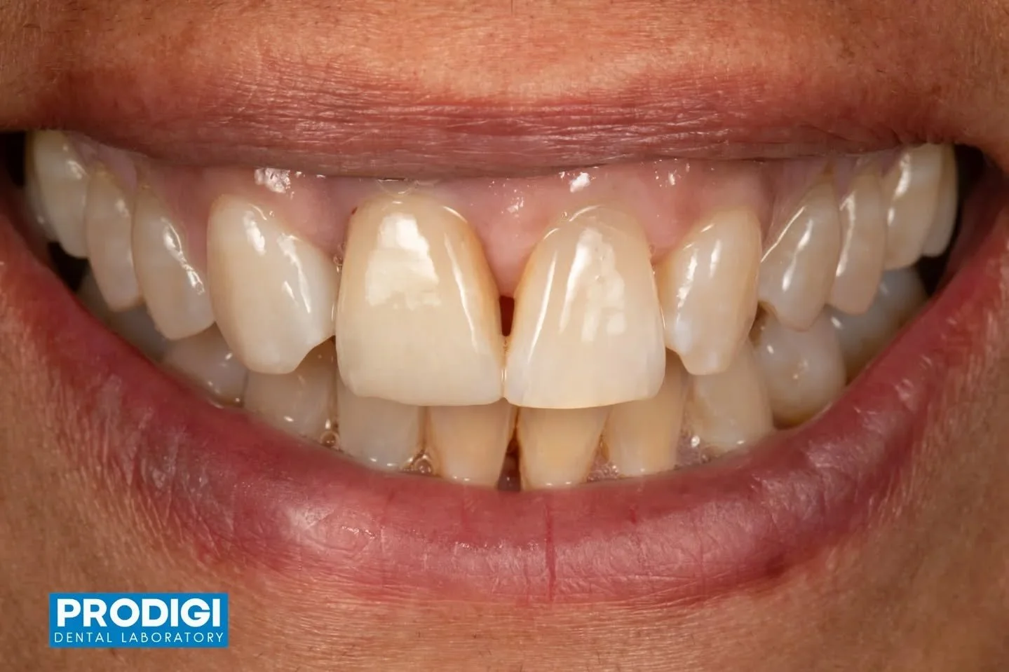 10-month follow-up 🦷✨
Can you spot the implant?
Stable, esthetic, and functioning as planned.

Restorations include an e.max crown on 7 and a custom abutment with zirconia coping + e.max crown on 8, maintaining strength and natural esthetics over ti