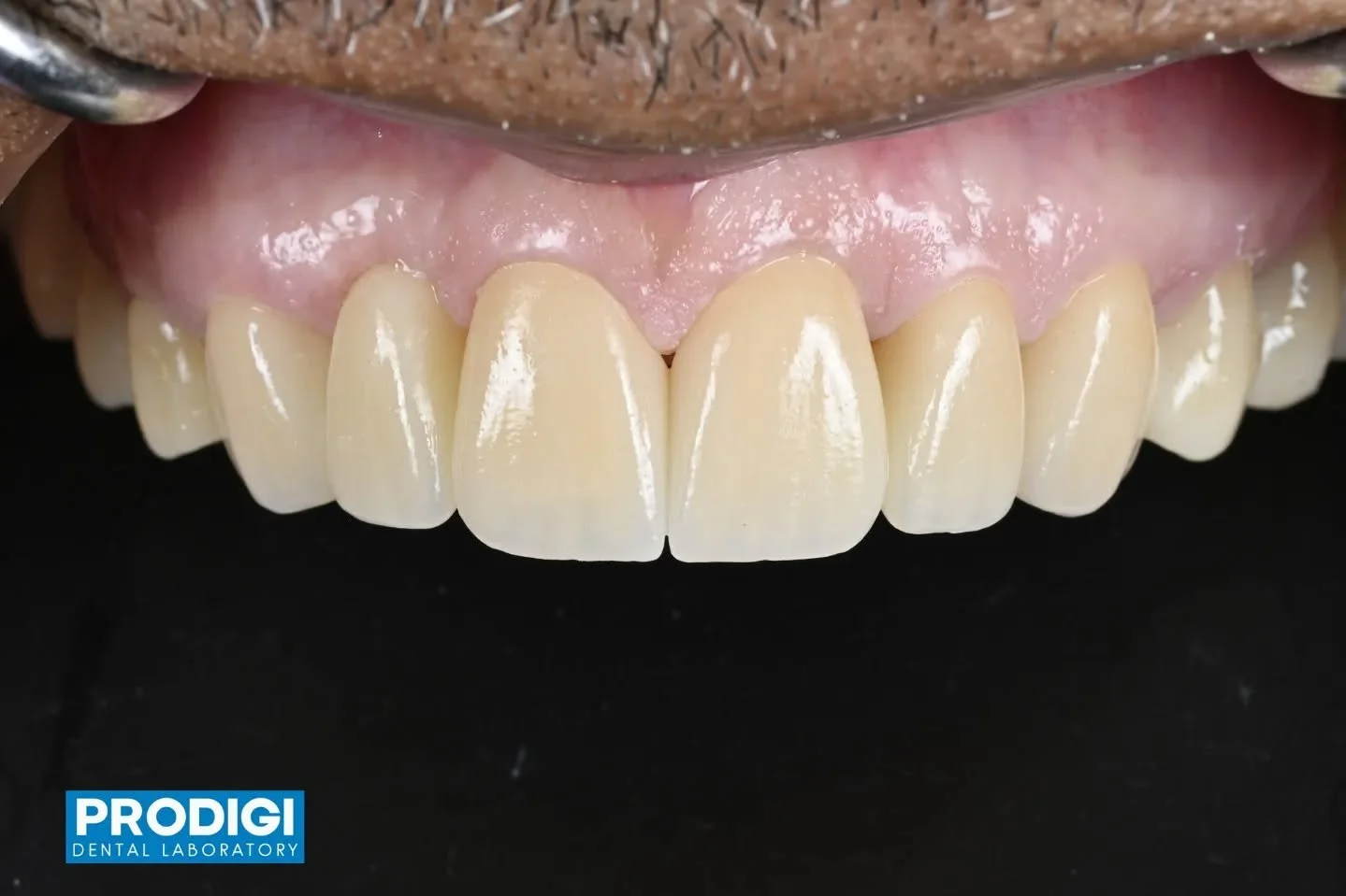 Maxillary anterior restorations using the cutback and micro-layering technique with Ivoclar Ceram Art 🦷✨
Carefully layered to achieve natural translucency, depth, and lifelike esthetics.
#Ivoclar #CeramArt #MicroLayering #CutbackTechnique  #ProdigiD