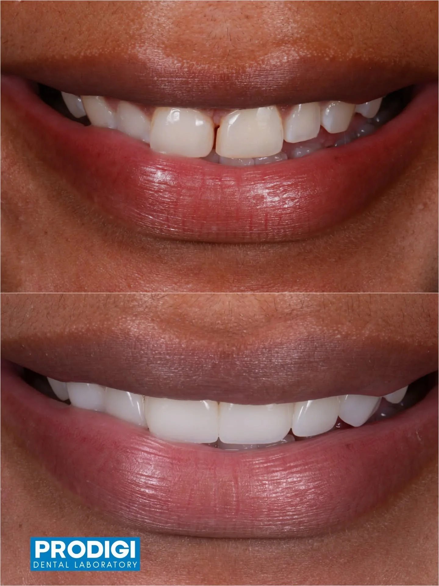 Maxillary anterior veneers crafted with EZneer monolithic zirconia 🦷✨
Surface treated with etching solution to enhance bonding strength while maintaining clean, natural esthetics.
#EZneer #AnteriorEsthetics #EtchedZirconia #DigitalDentistry #Prodigi