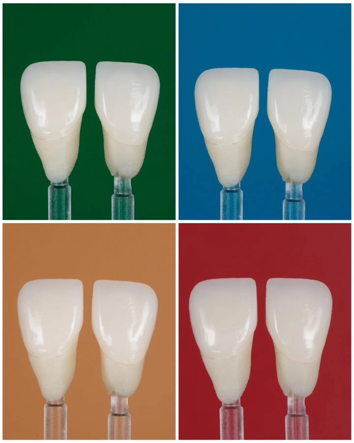 anterior crowns in lithium disilicate &mdash; natural, translucent, and precise 👌
#SmileDesign #LithiumDisilicate #DentalRestoration #ProdigiDentalLab