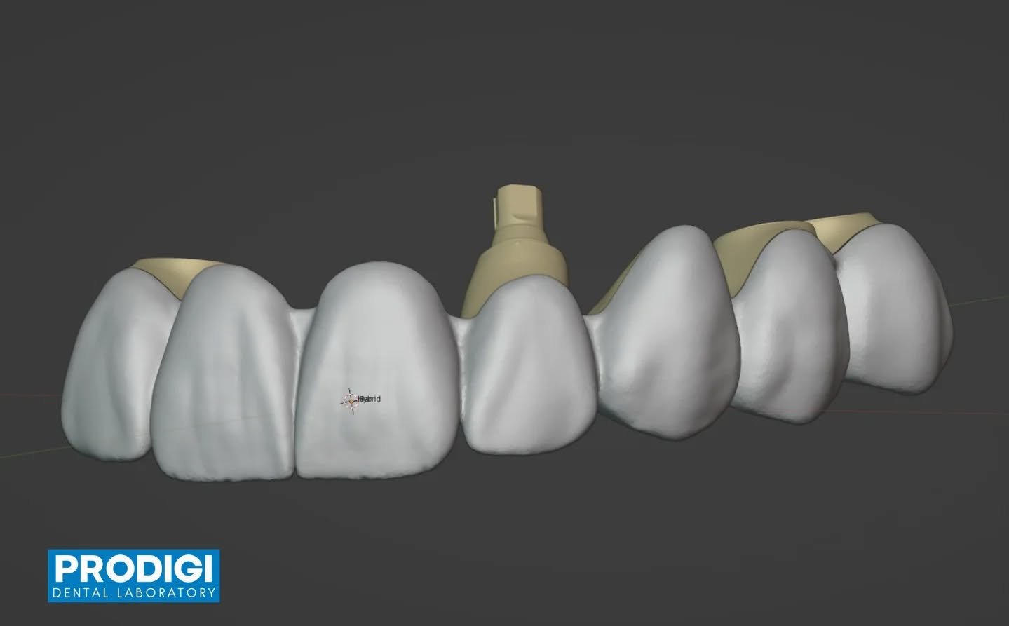 Maxillary #7&ndash;13 FP1 implant bridge supported by 4 implants 🦷✨
Designed with 3 MUA conversions and 1 bone-level implant connection, utilizing a custom I-bar framework for passive fit, strength, and long-term stability.

Precision-engineered for