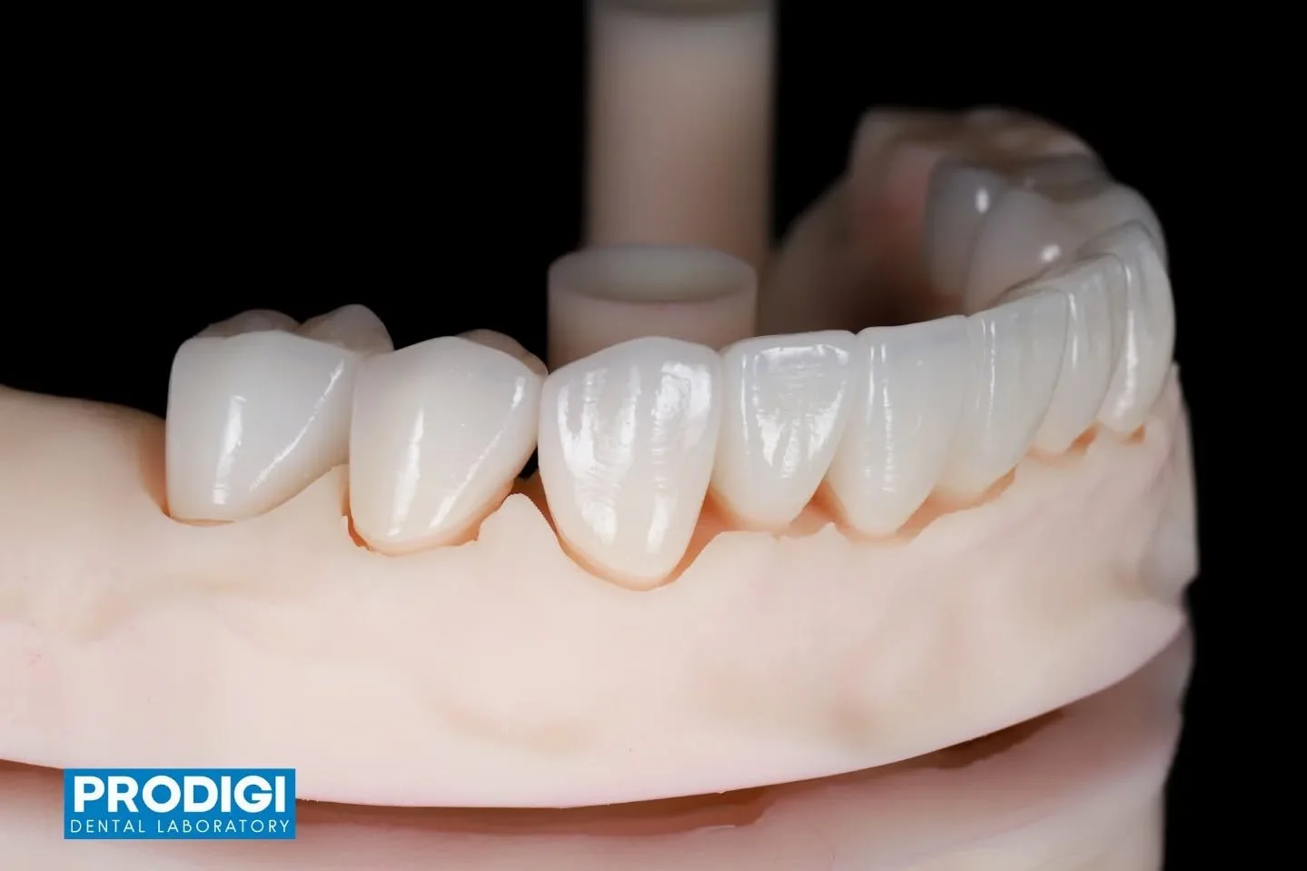 Lower arch restorations completed with monolithic zirconia crowns 🦷✨
Designed for strength, precision, and long-term durability while maintaining clean, natural esthetics.

Built to function. Crafted to last.
#MonolithicZirconia  #Prosthodontics #Di