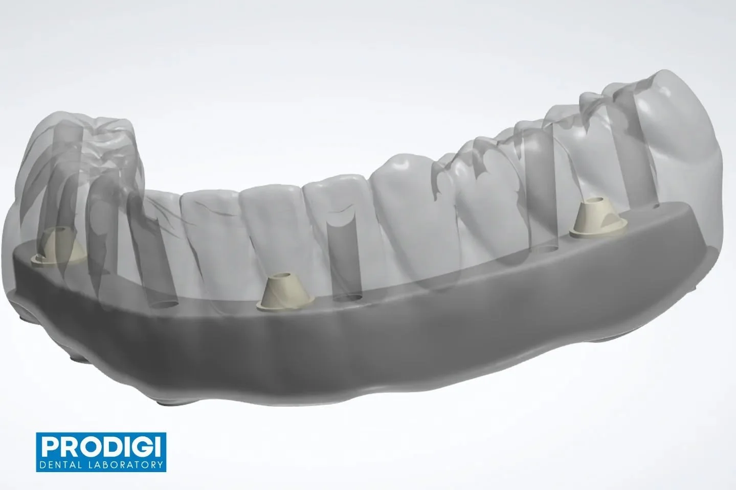 Custom All-on-X titanium I-bar restoration with integrated MUA abutment connection 🔩🦷

Designed with a direct-screw retention mechanism between the titanium bar and acrylic prosthesis &mdash; in addition to conventional cementation &mdash; to enhan